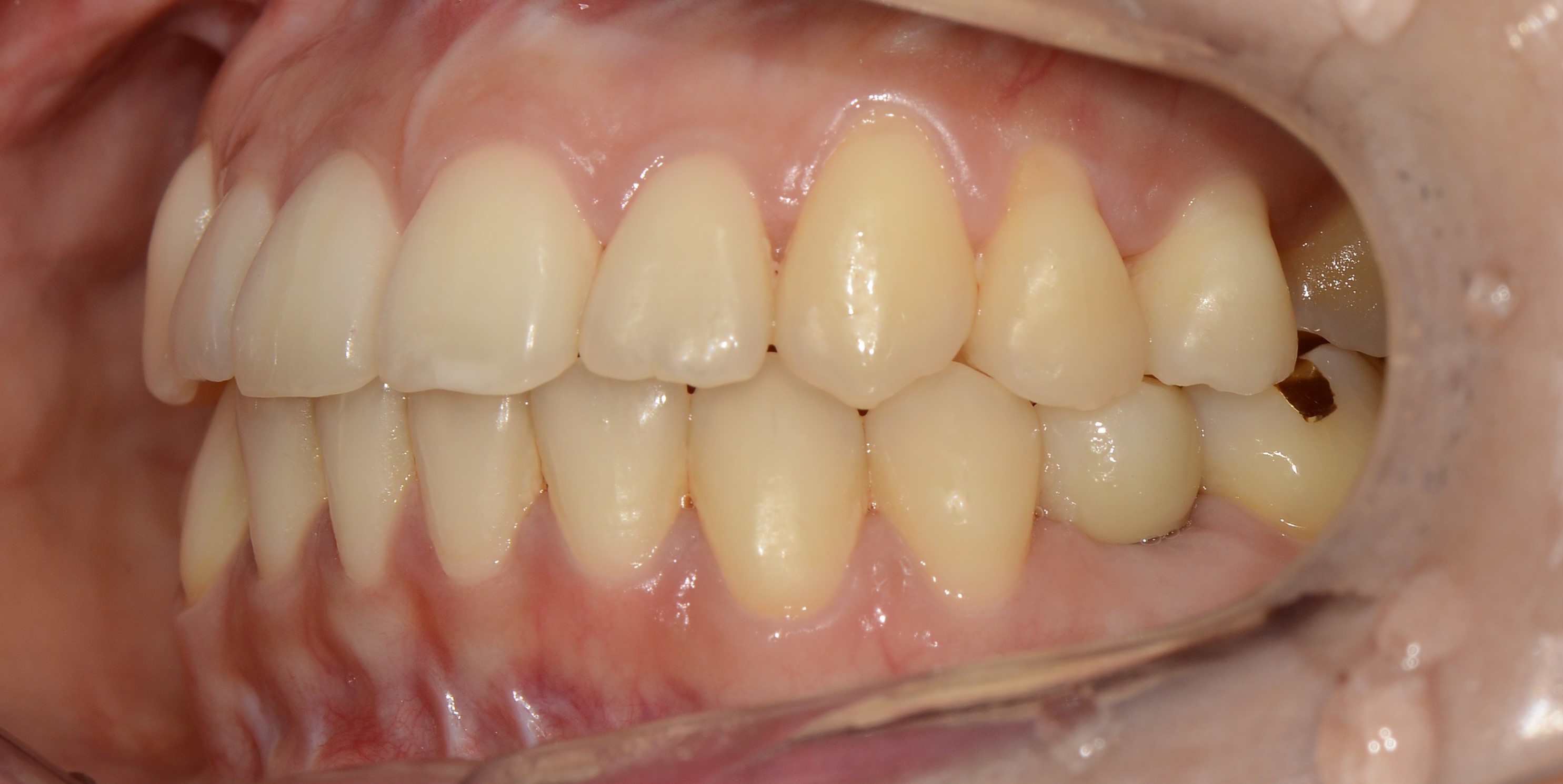 치료 후 사진입니다.