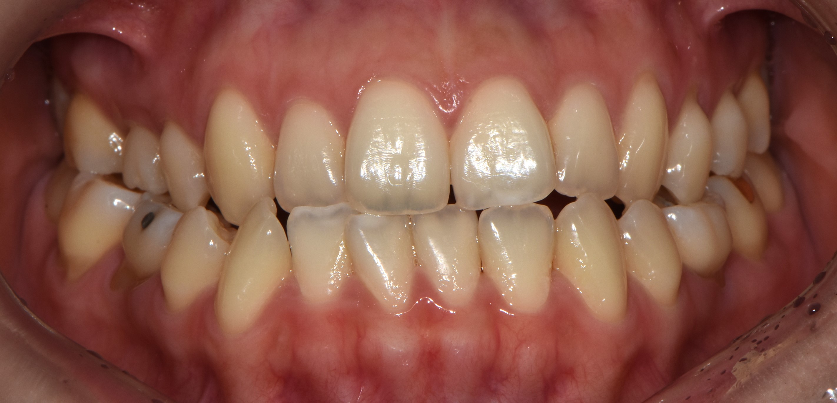 치료 전 사진입니다.