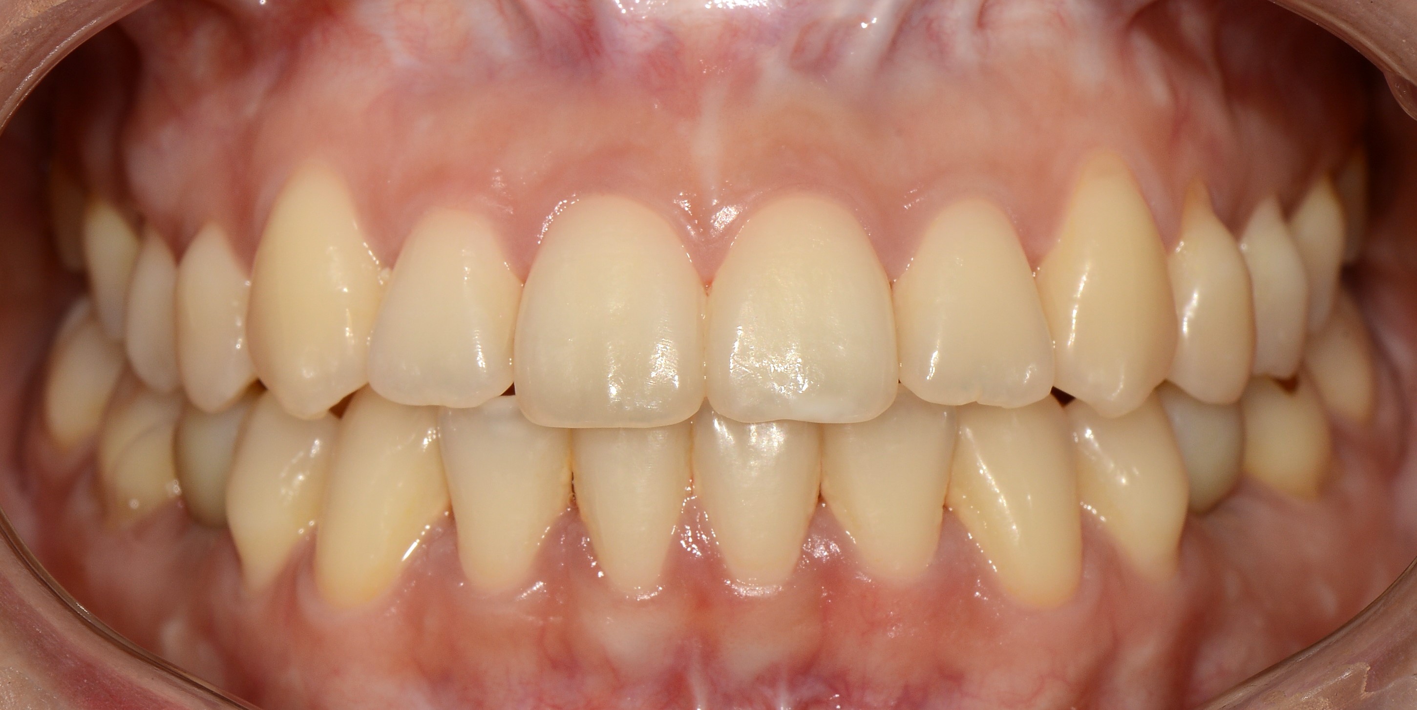 치료 후 사진입니다.