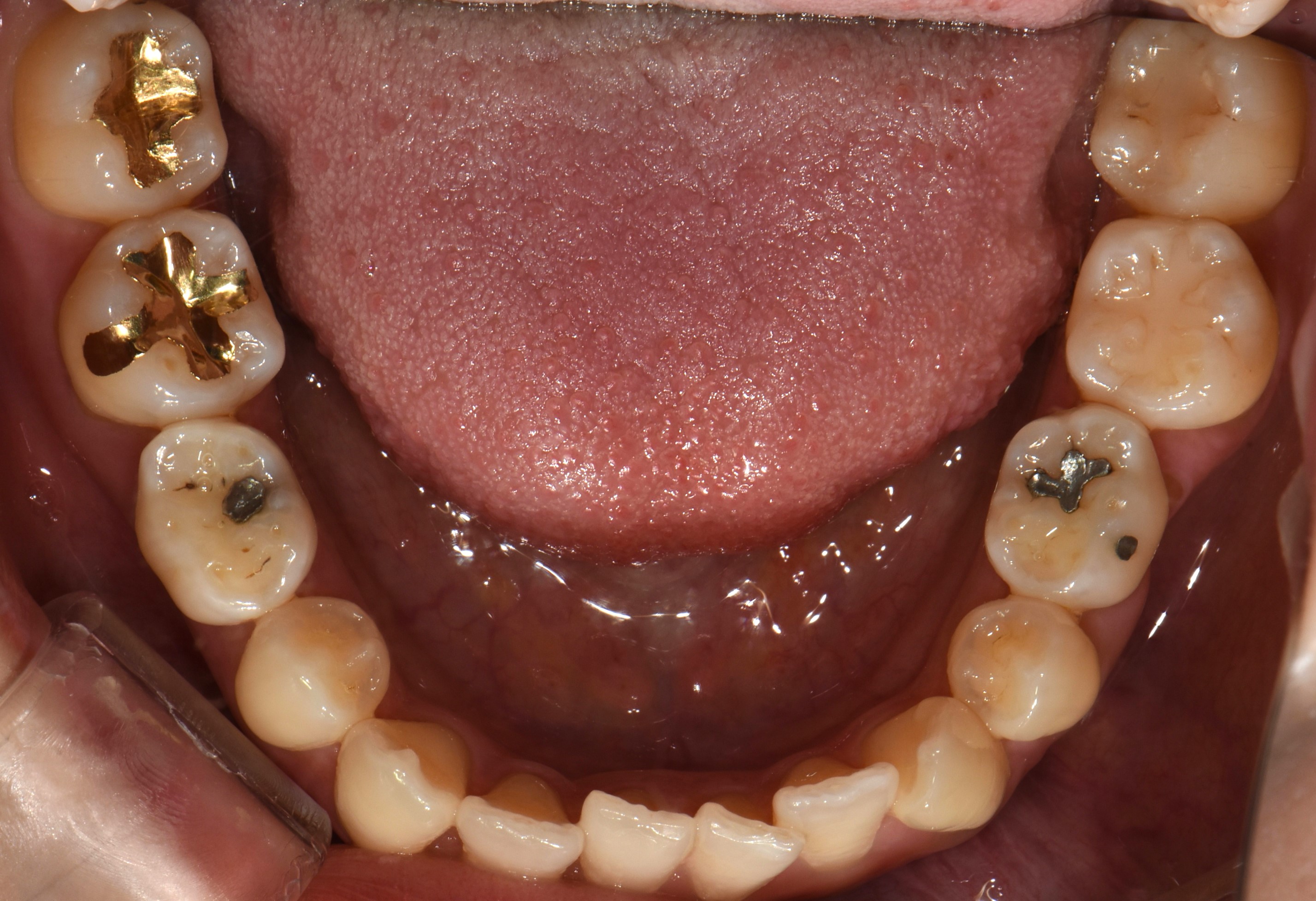 치료 전 사진입니다.