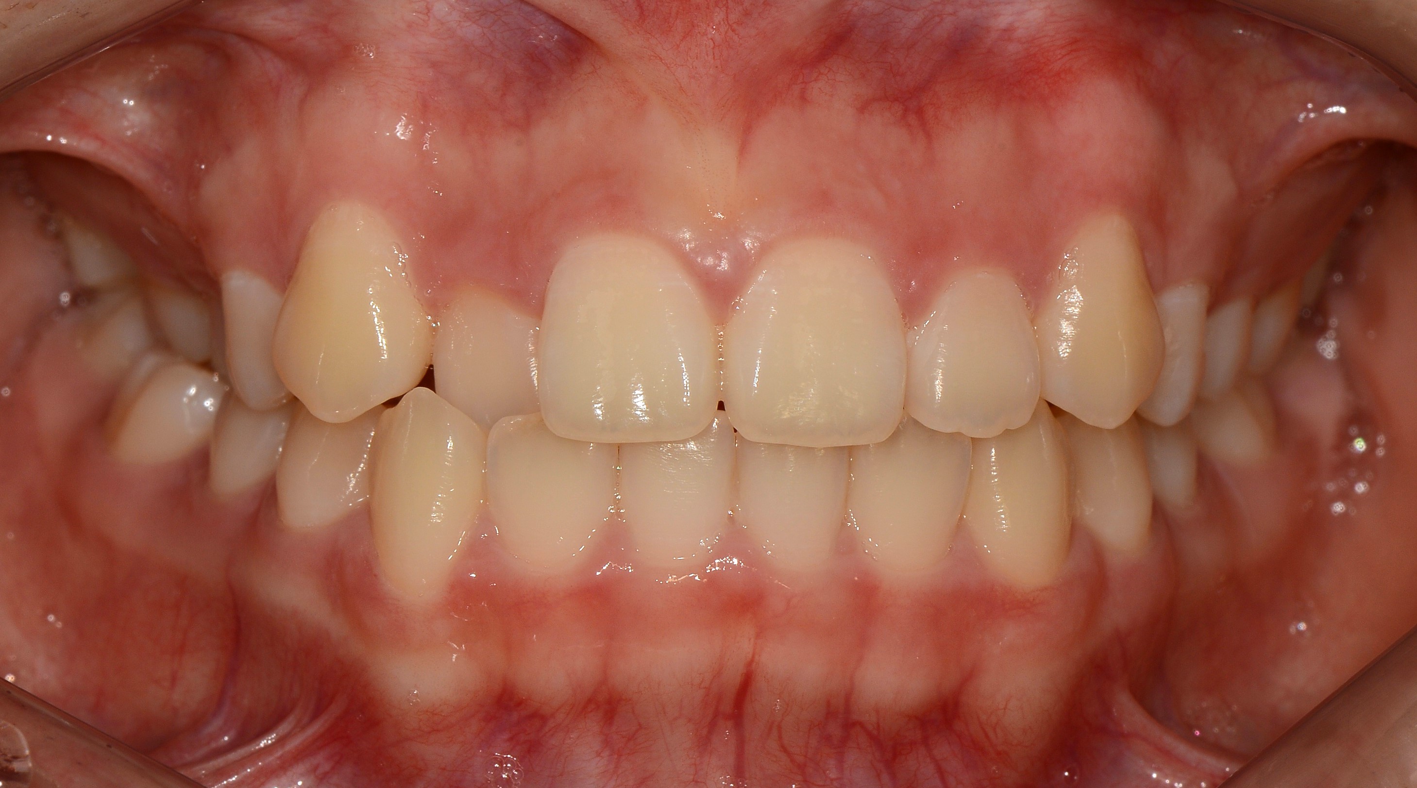 치료 전 사진입니다.