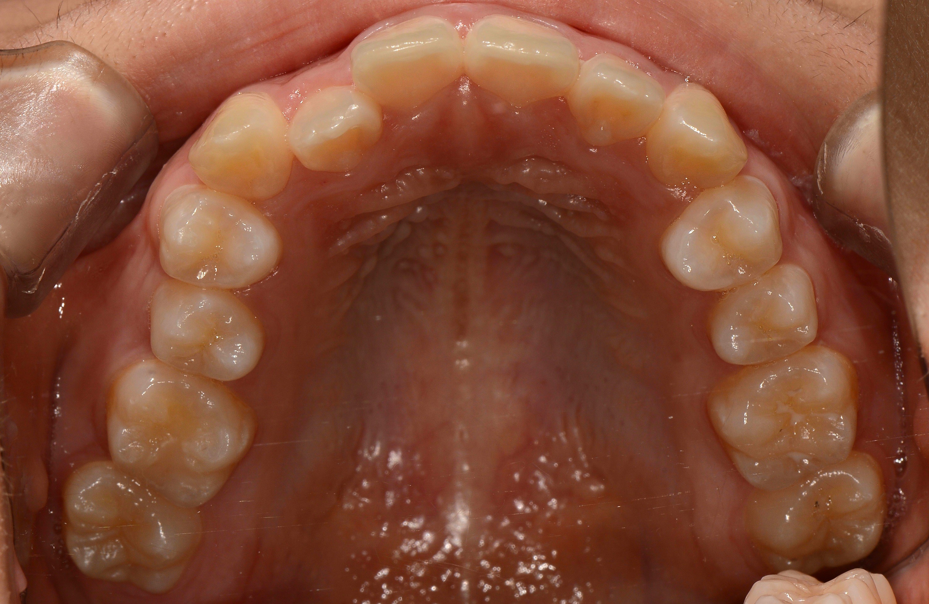 치료 전 사진입니다.