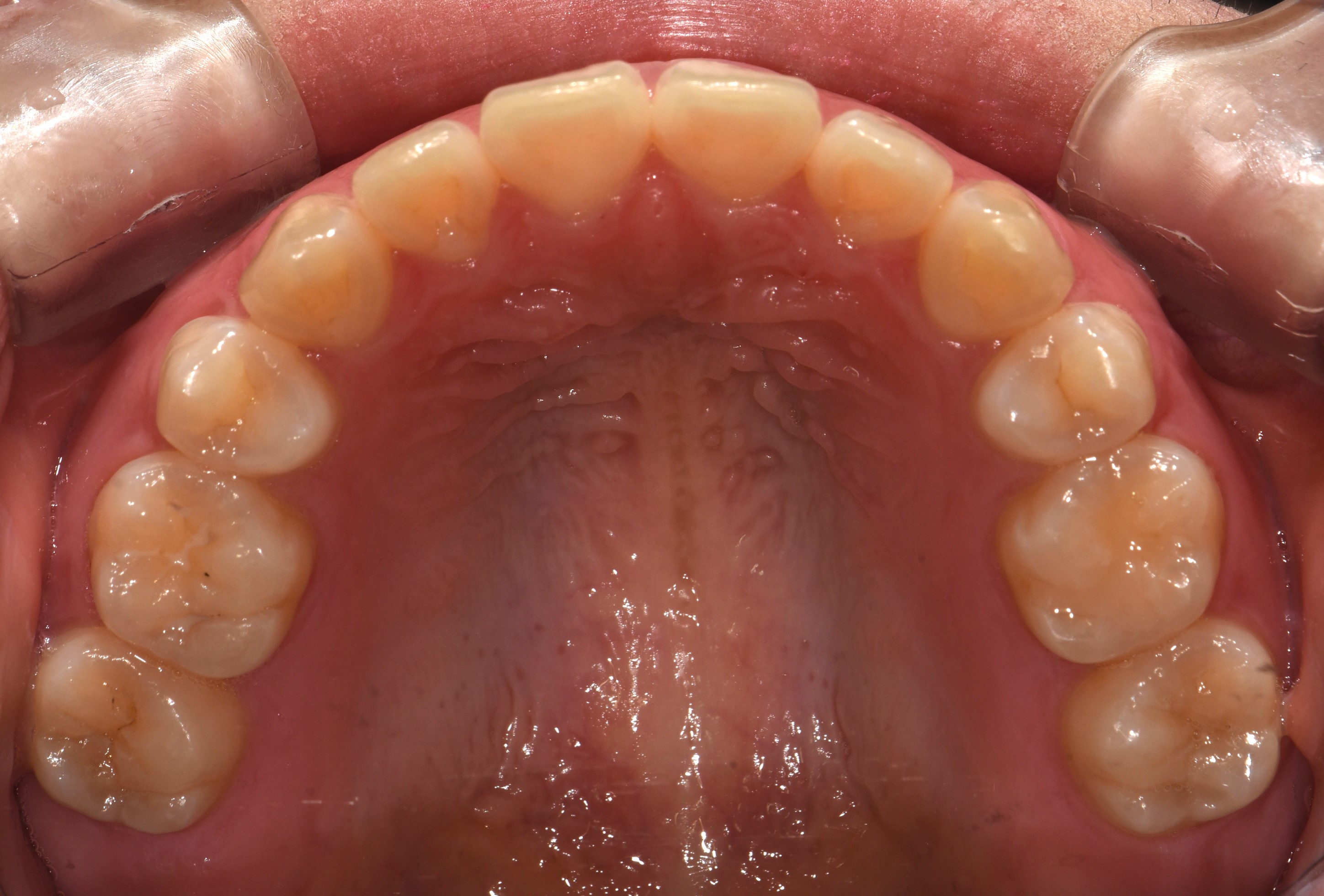 치료 후 사진입니다.