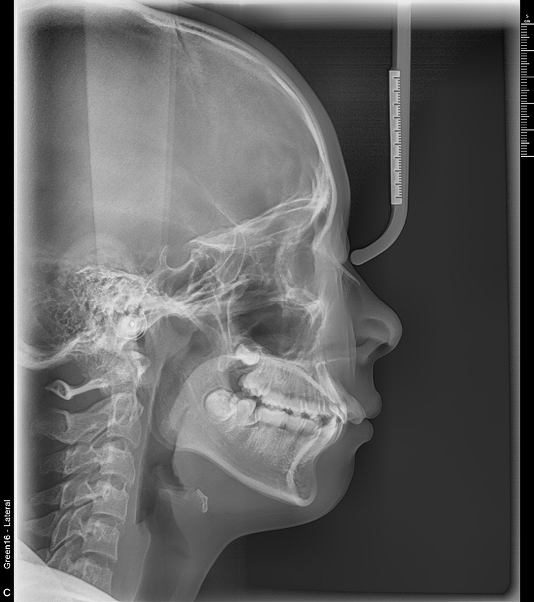 치료 전 사진입니다.