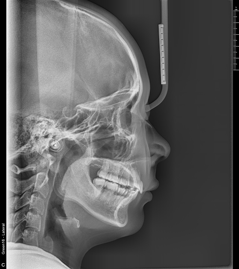 치료 후 사진입니다.