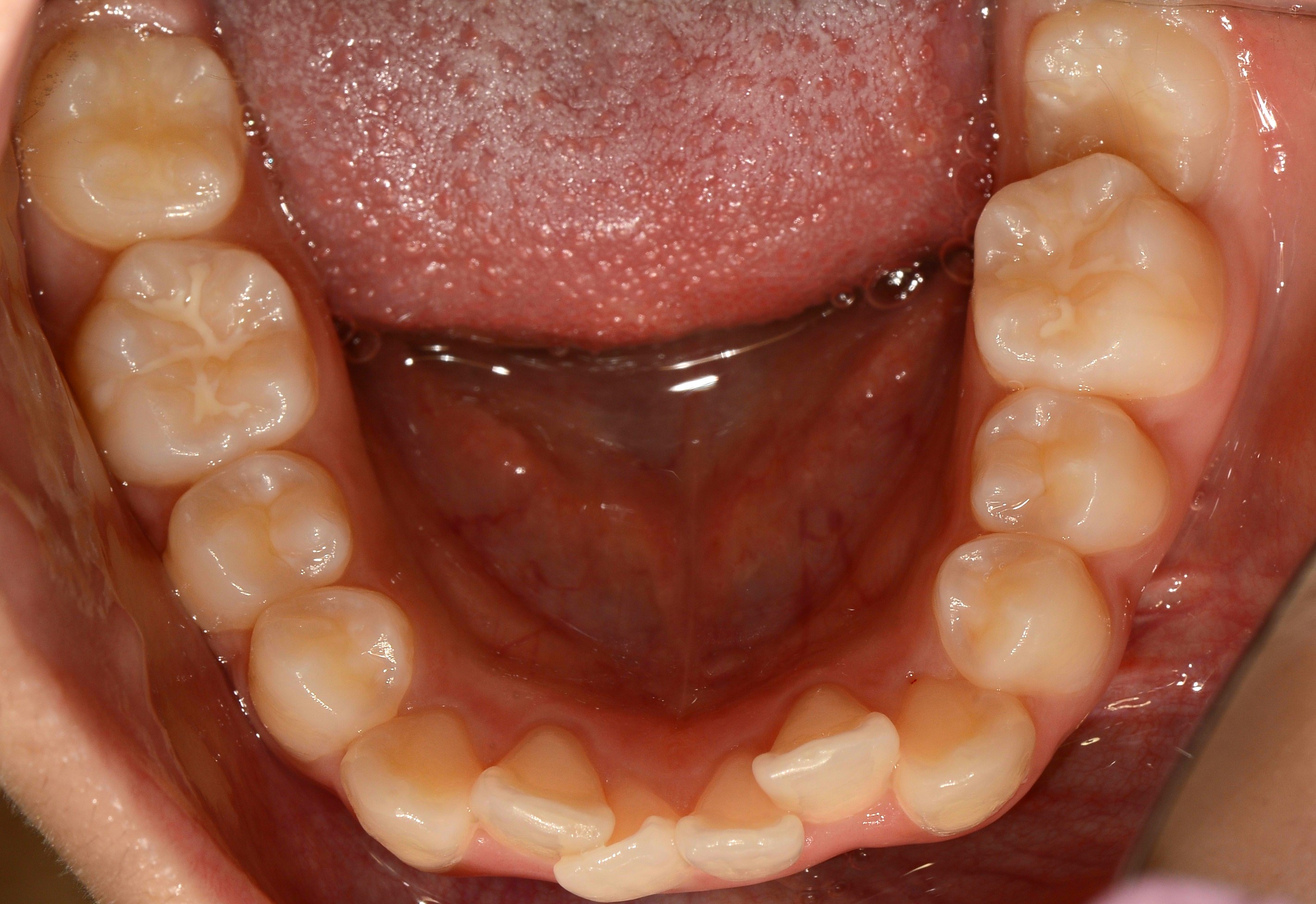 치료 전 사진입니다.