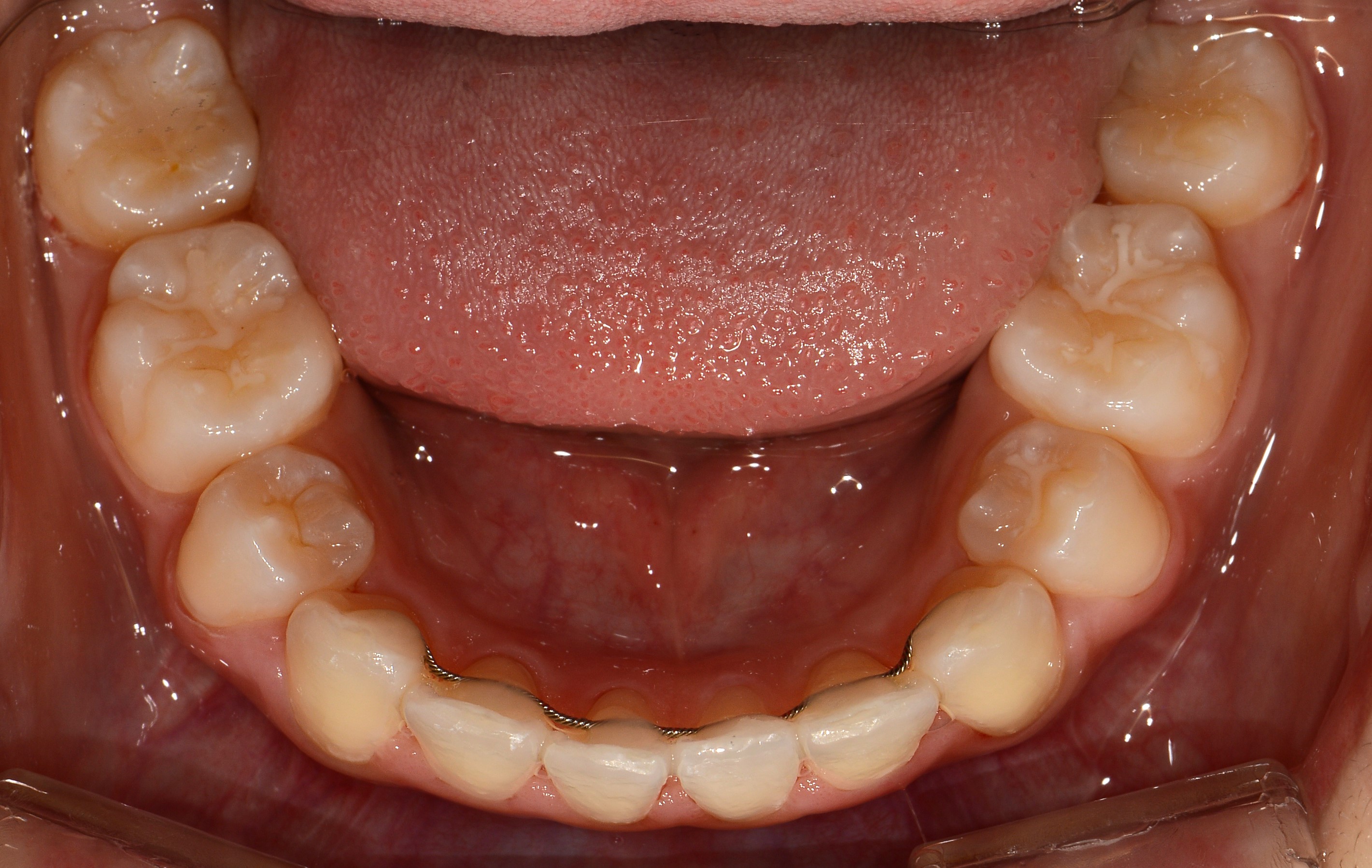치료 후 사진입니다.