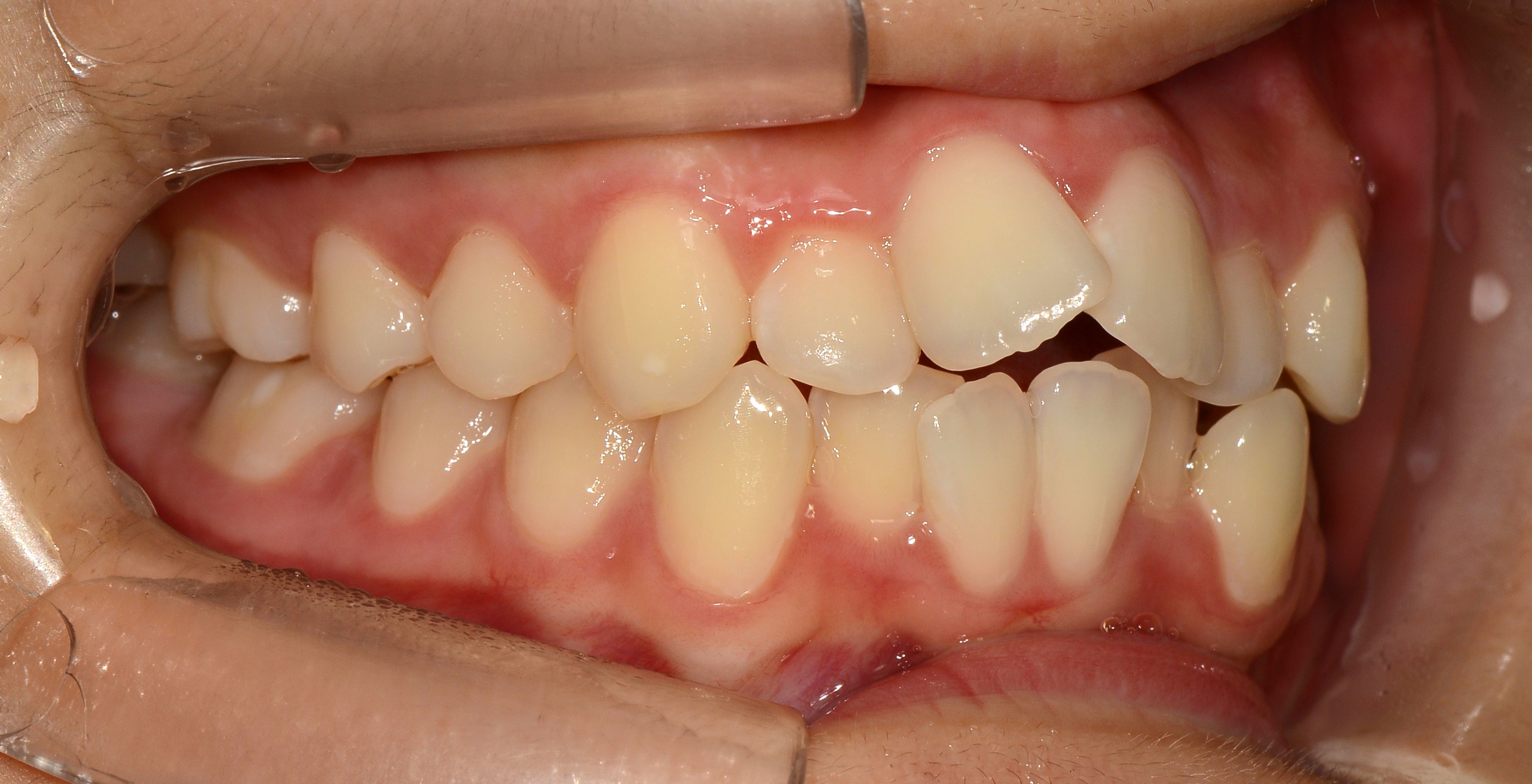 치료 전 사진입니다.