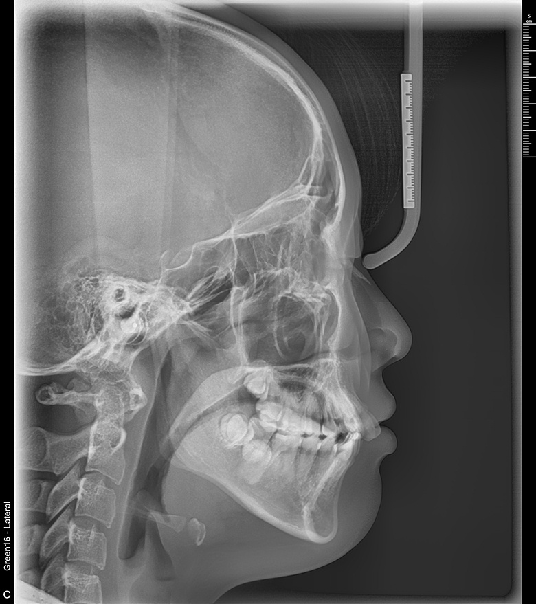 치료 전 사진입니다.