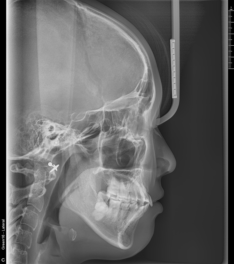 치료 후 사진입니다.