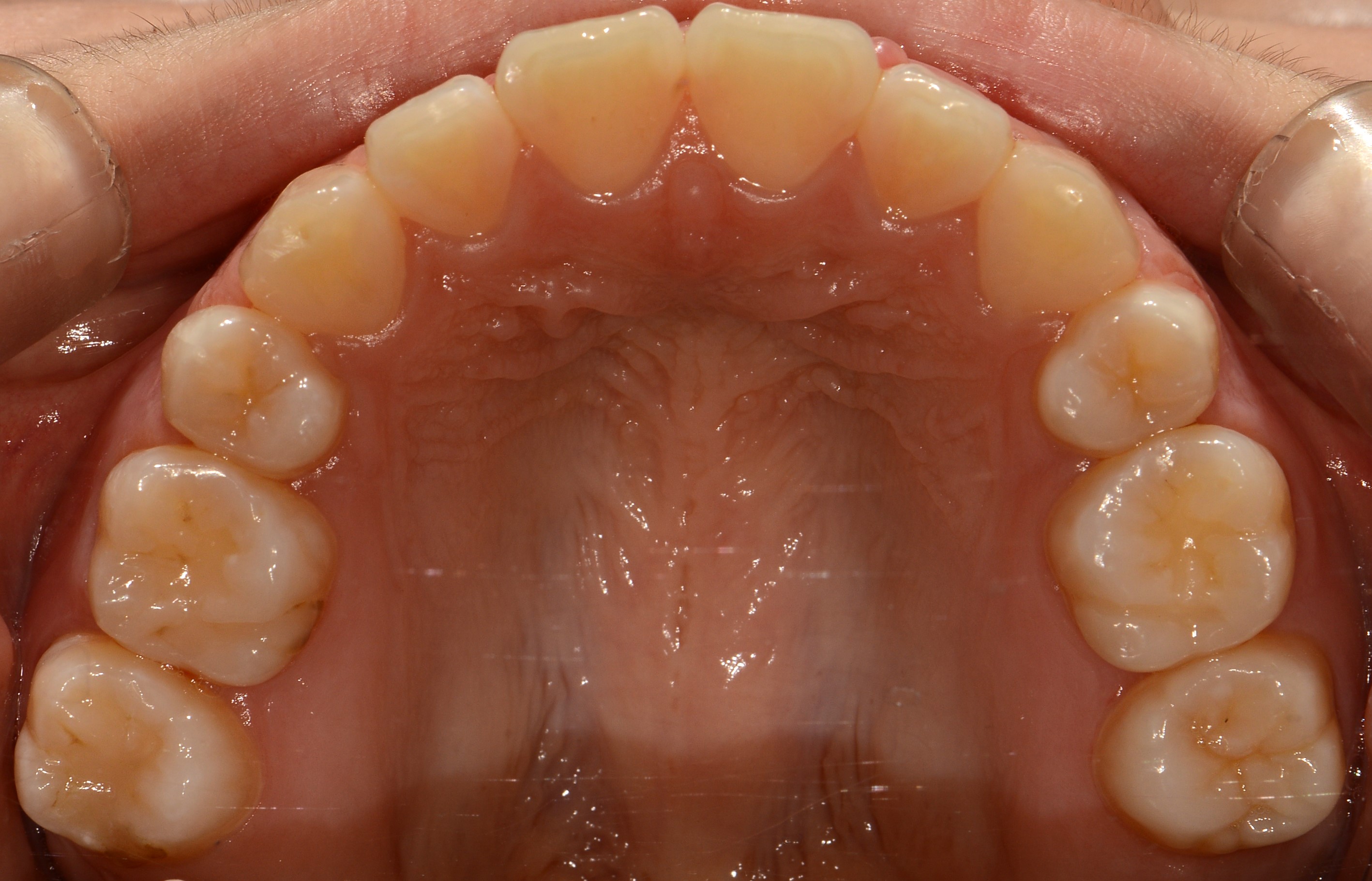 치료 후 사진입니다.