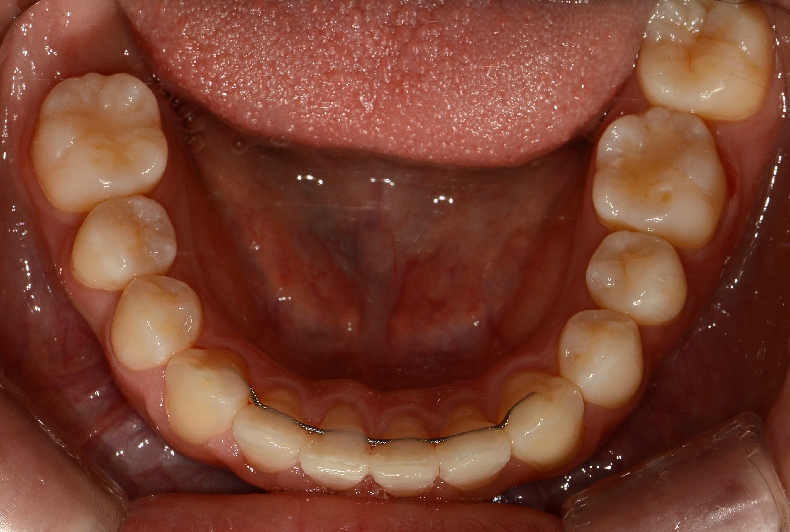 치료 후 사진입니다.