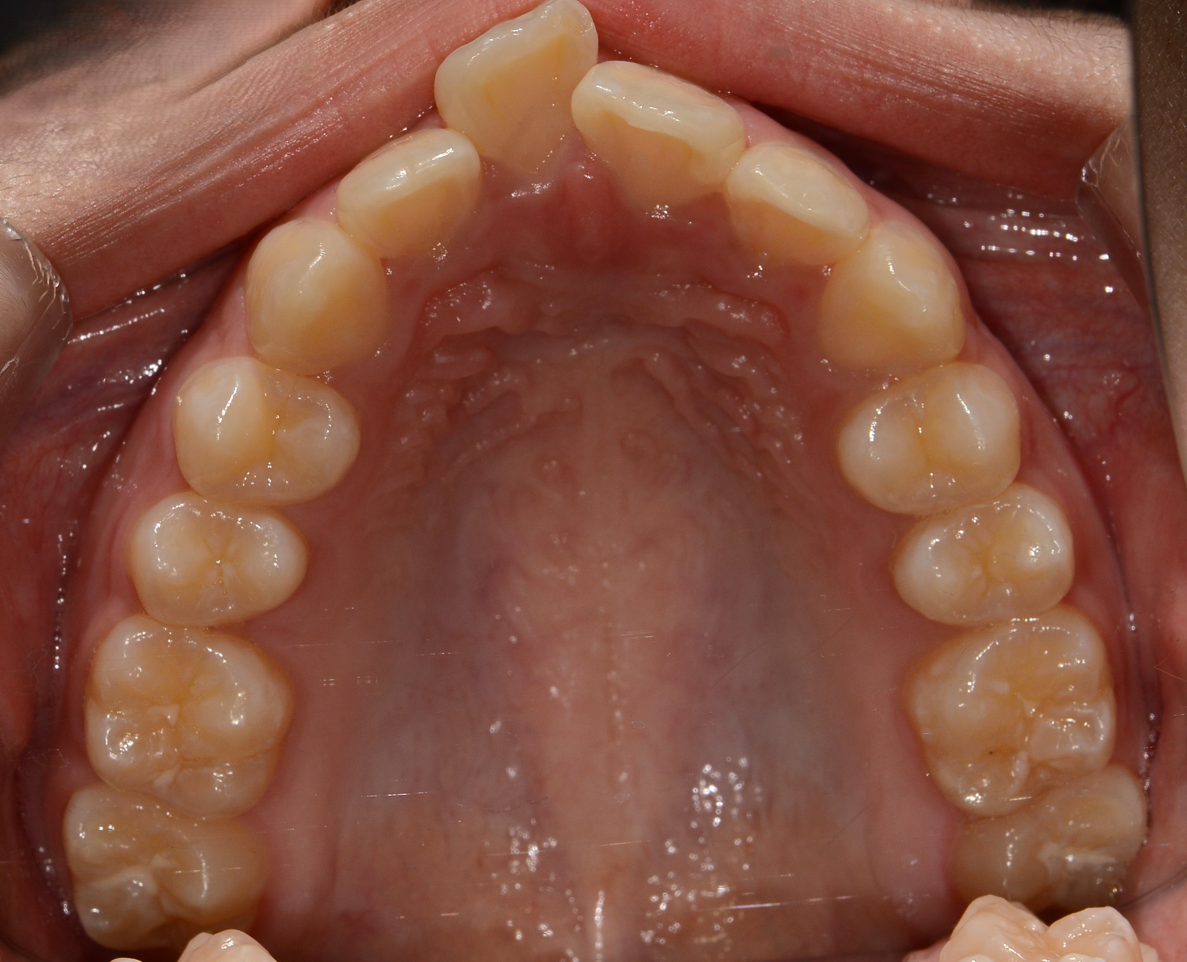 치료 전 사진입니다.