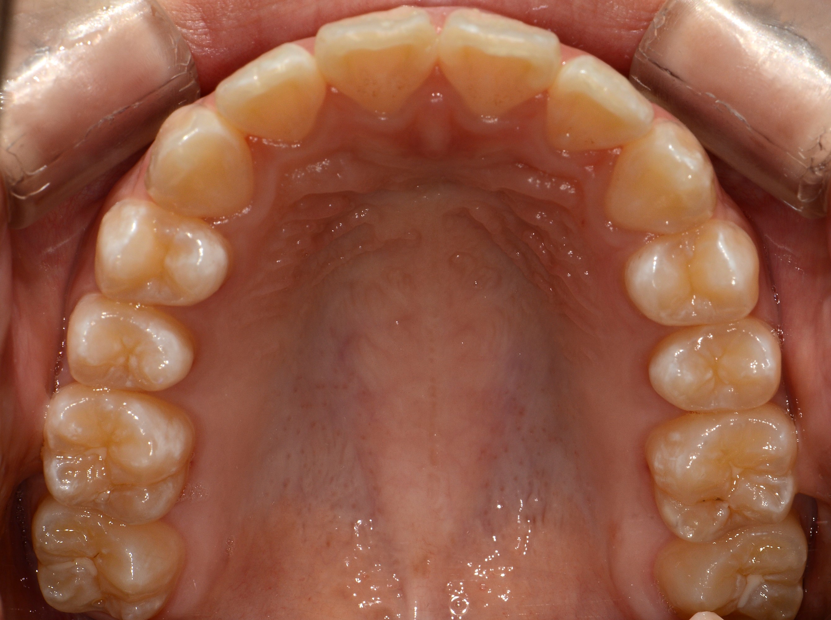 치료 후 사진입니다.