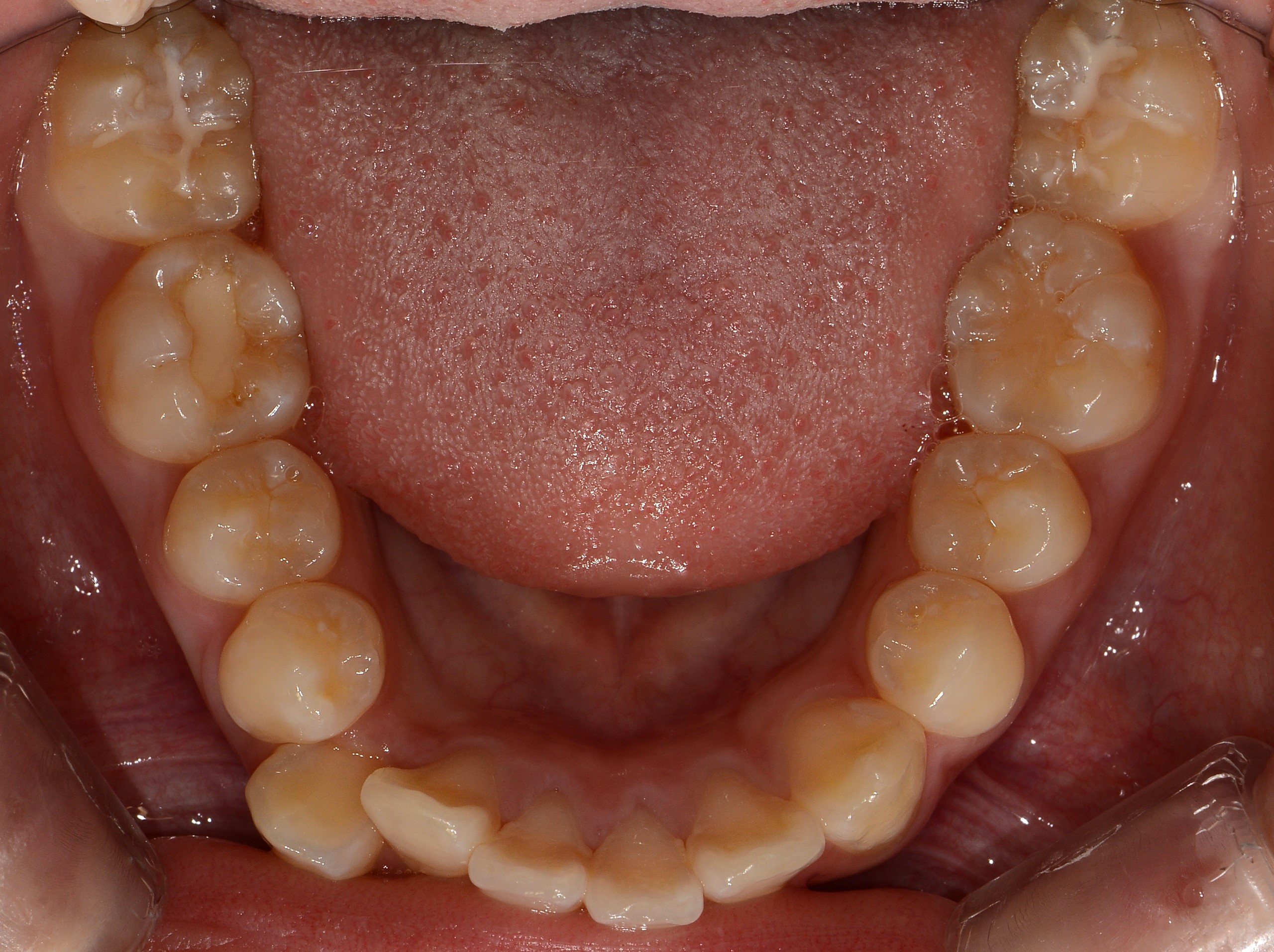 치료 전 사진입니다.