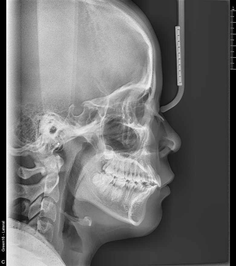 치료 후 사진입니다.