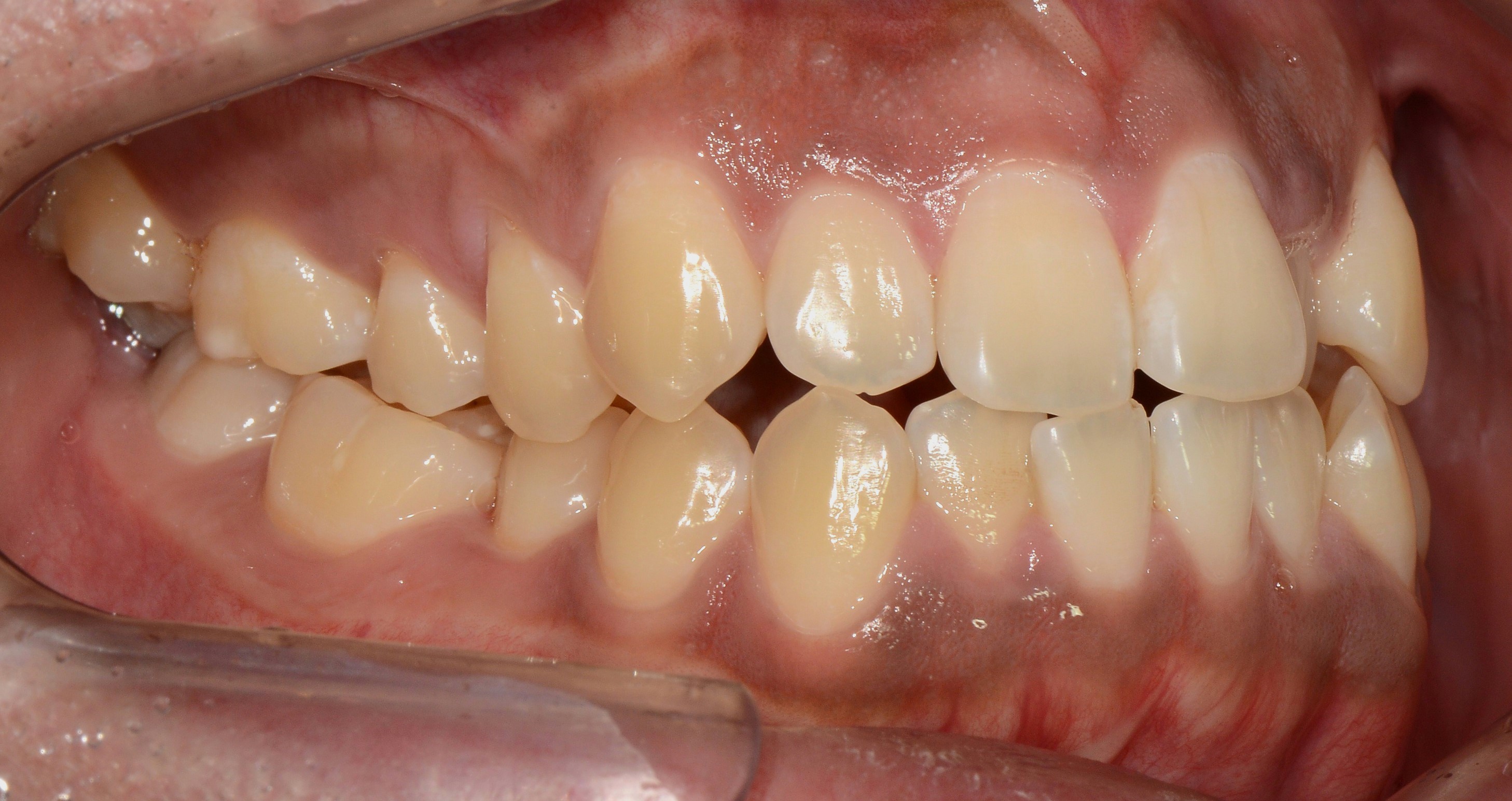 치료 전 사진입니다.