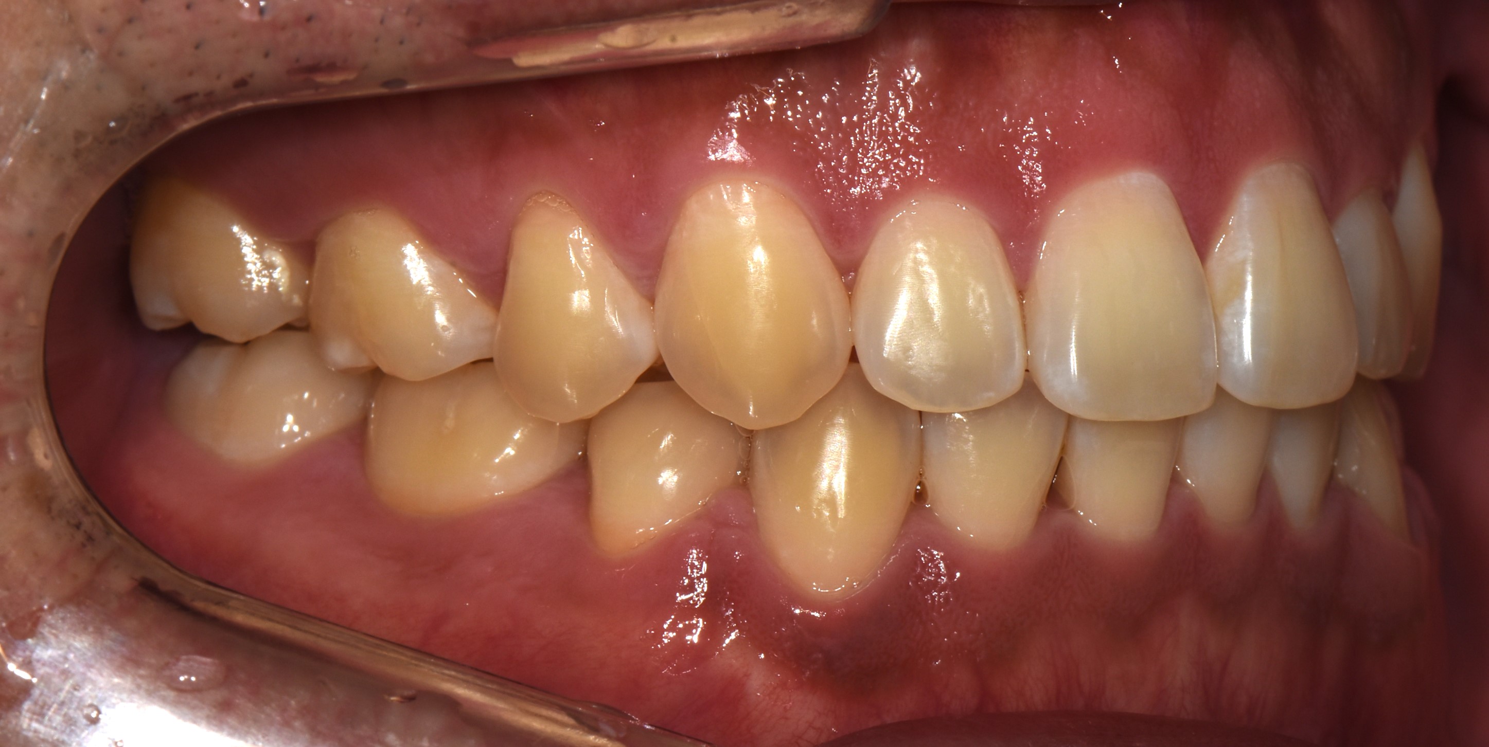 치료 후 사진입니다.