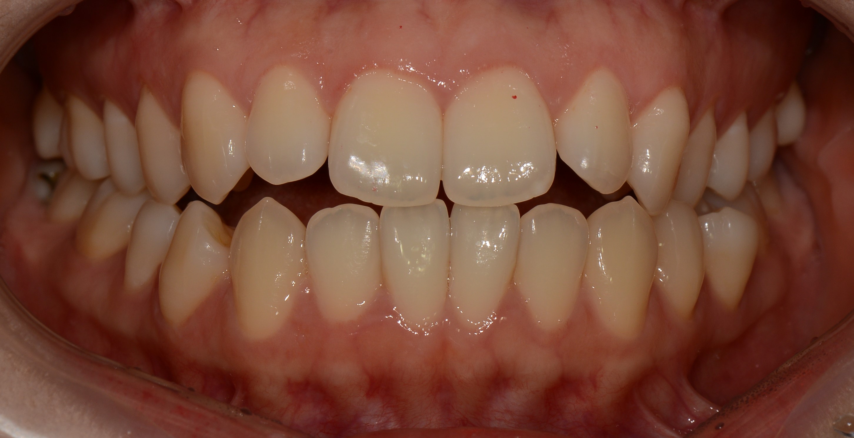 치료 전 사진입니다.