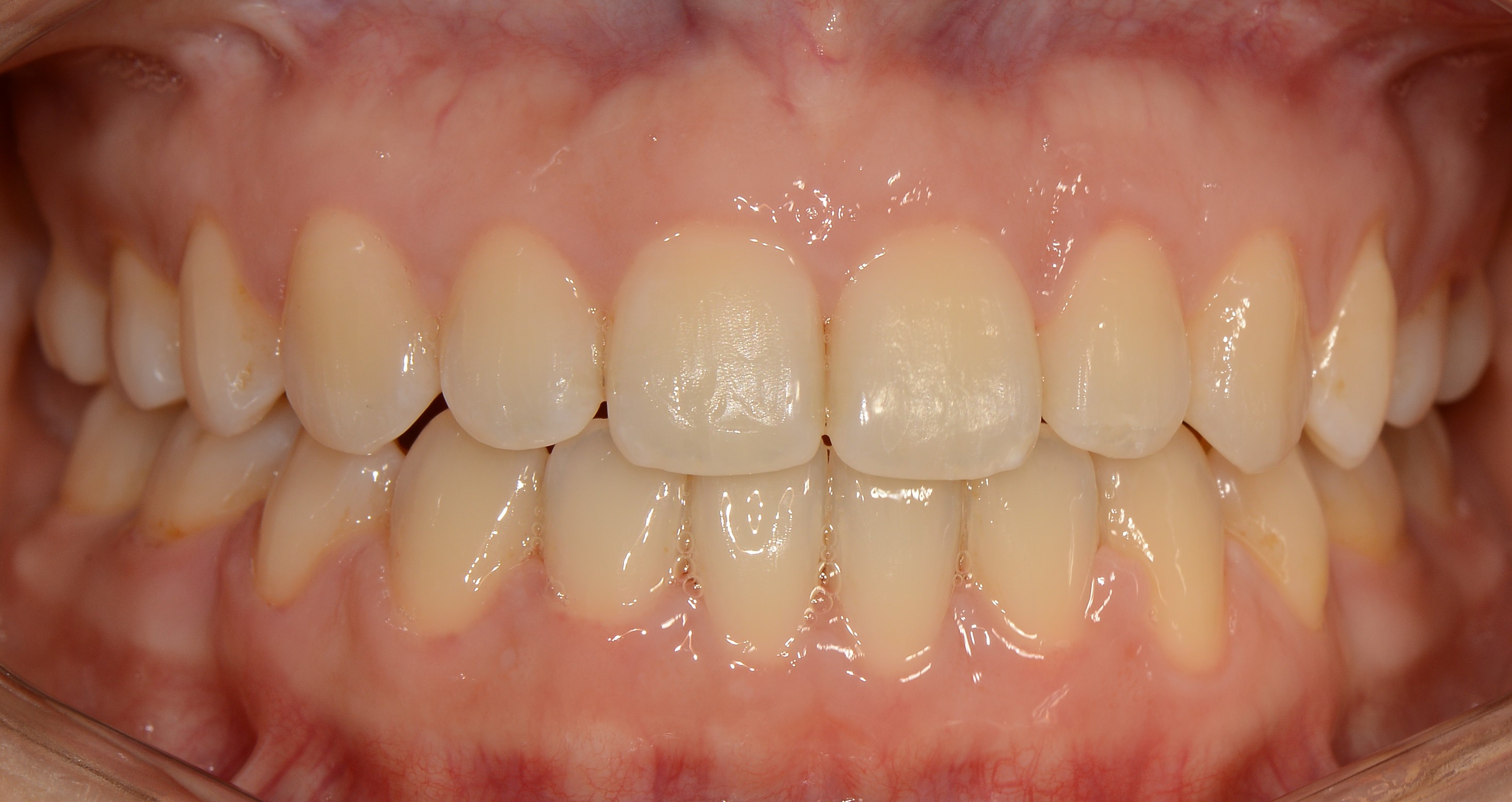 치료 후 사진입니다.