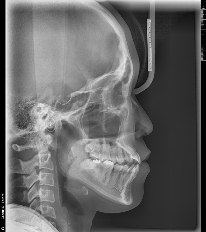 치료 전 사진입니다.