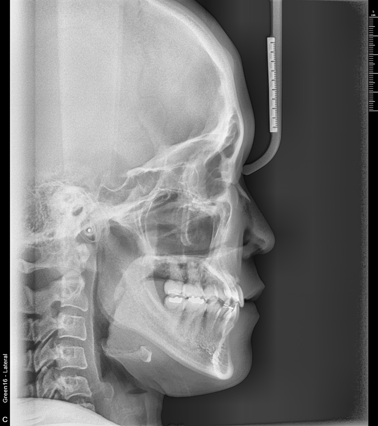 치료 후 사진입니다.