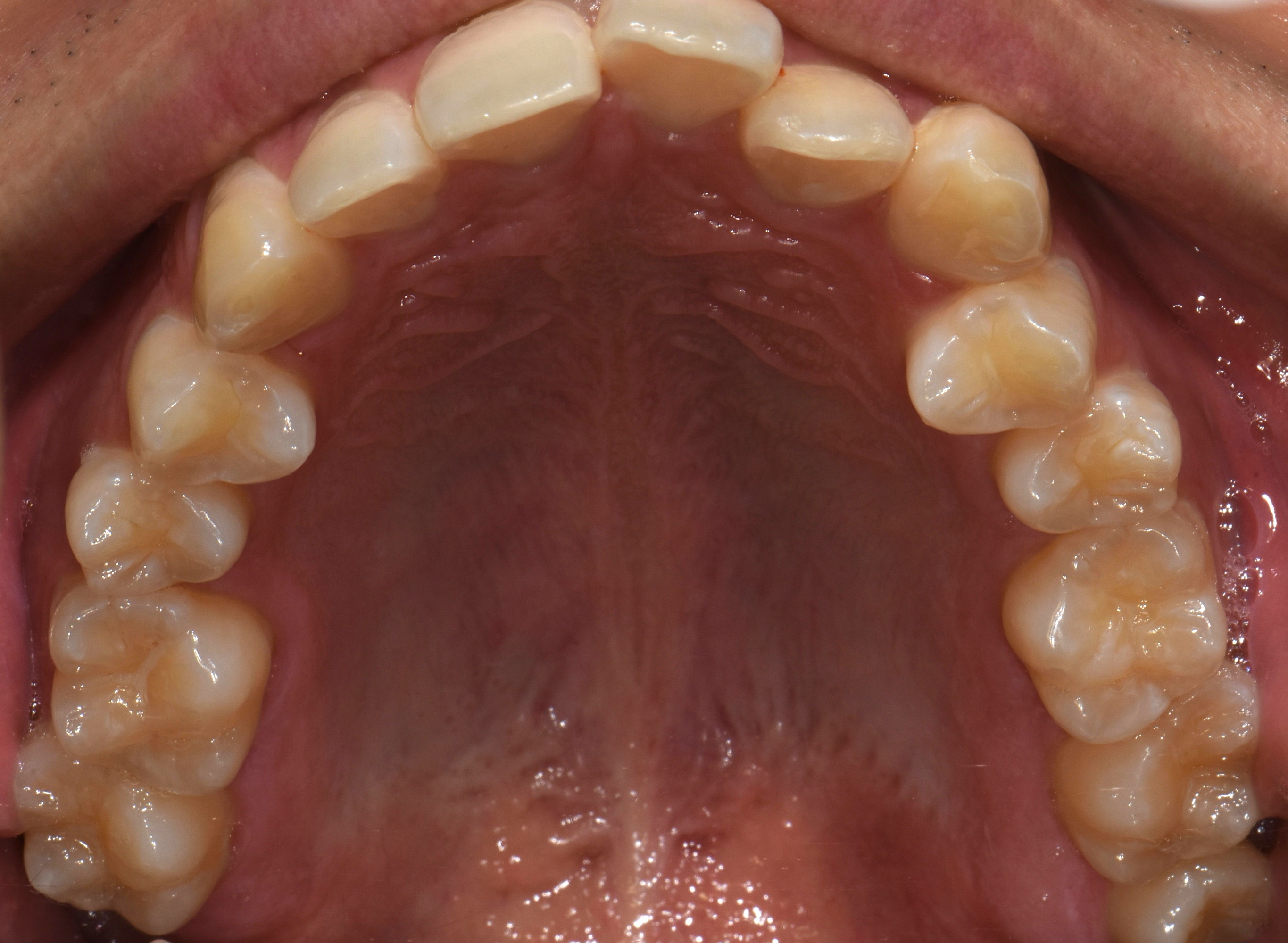 치료 전 사진입니다.