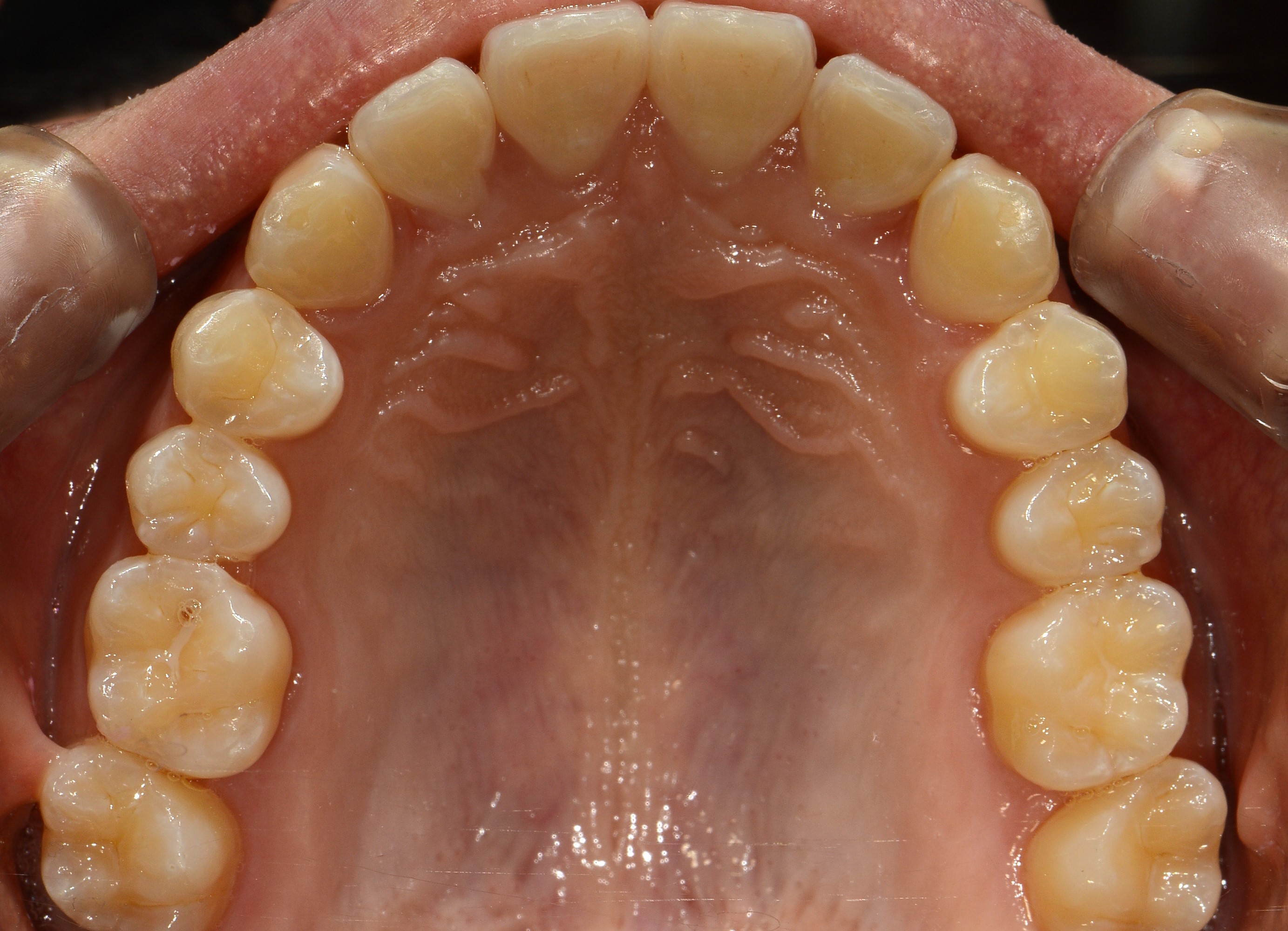 치료 후 사진입니다.