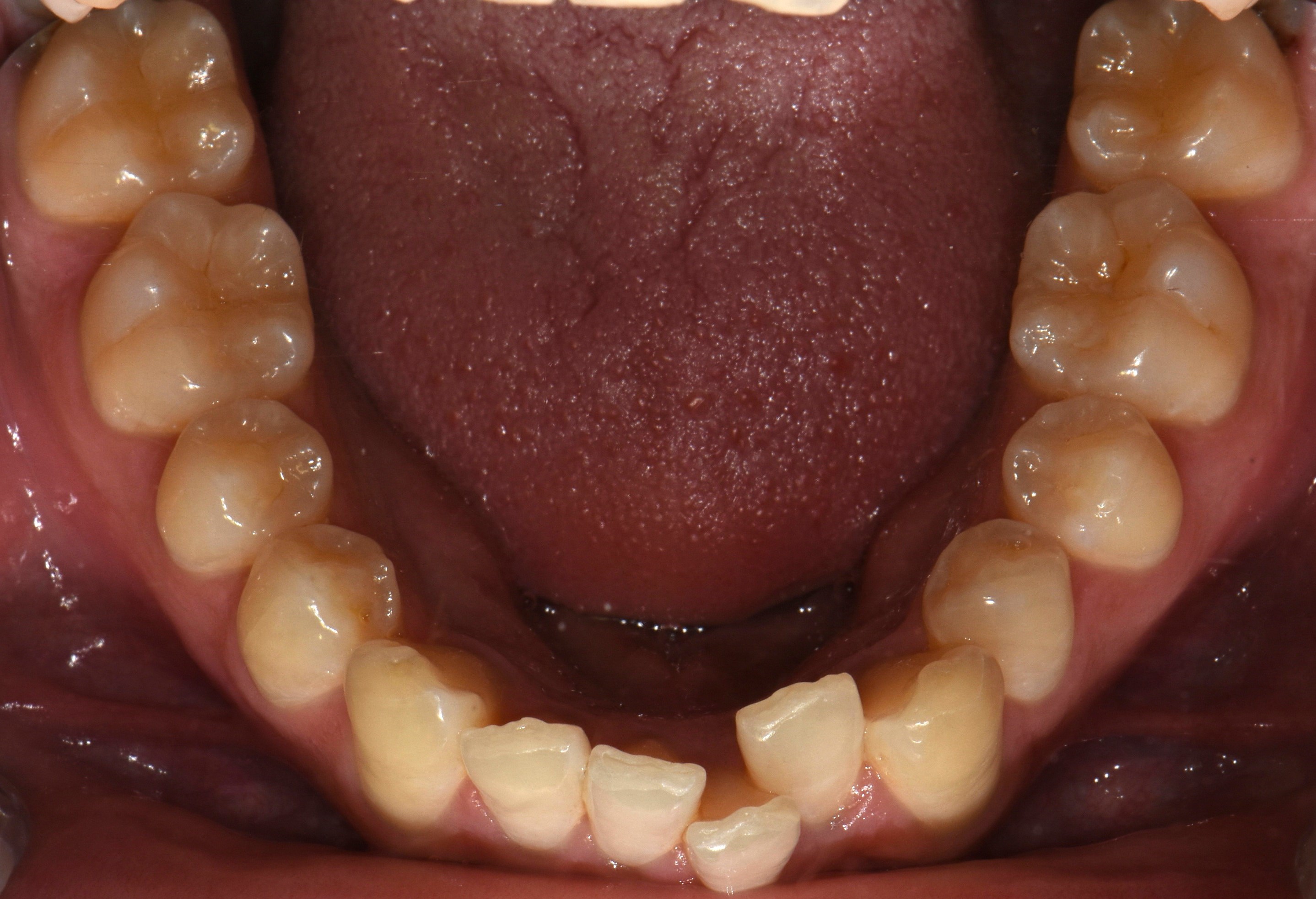치료 전 사진입니다.