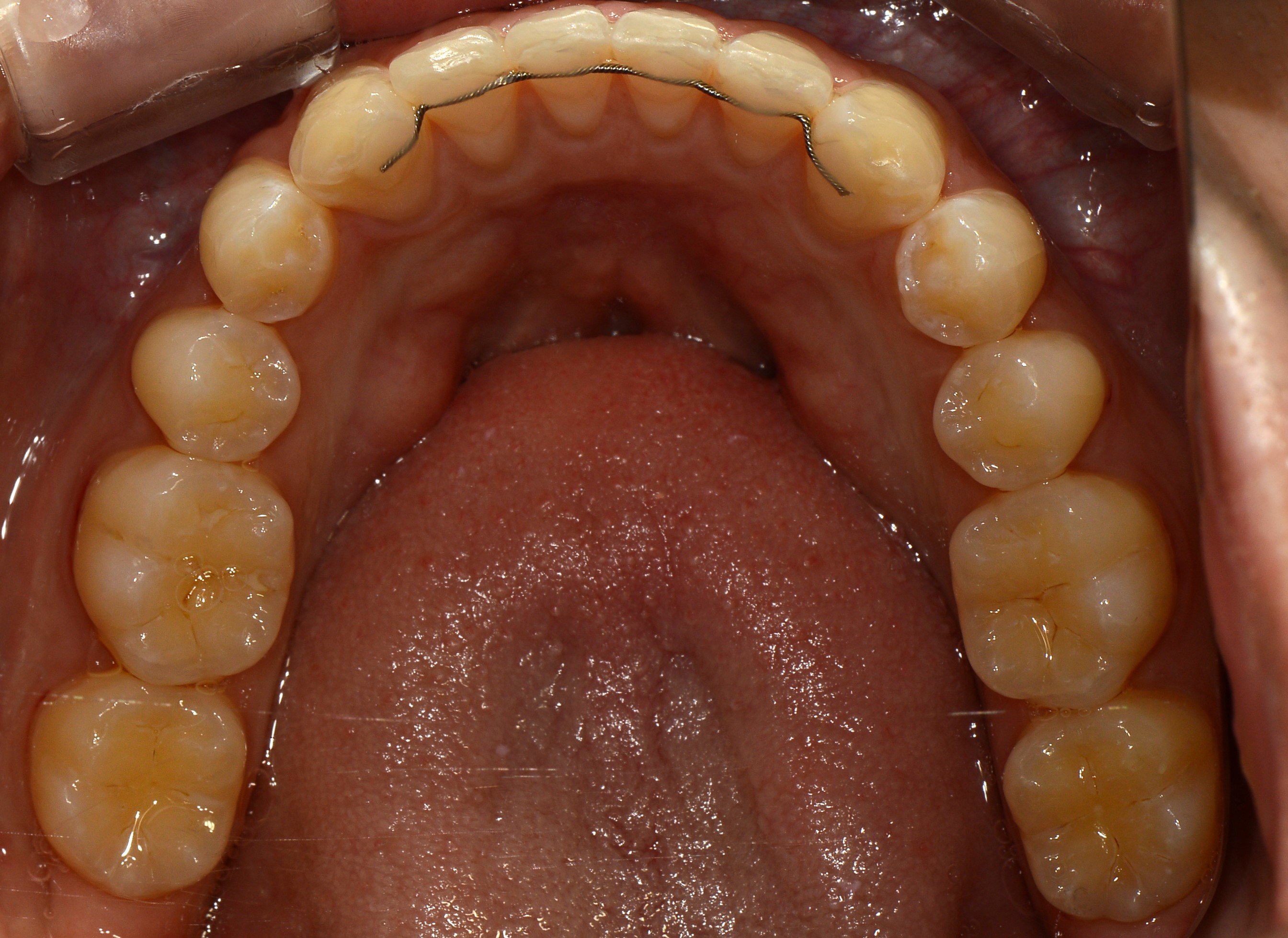 치료 후 사진입니다.