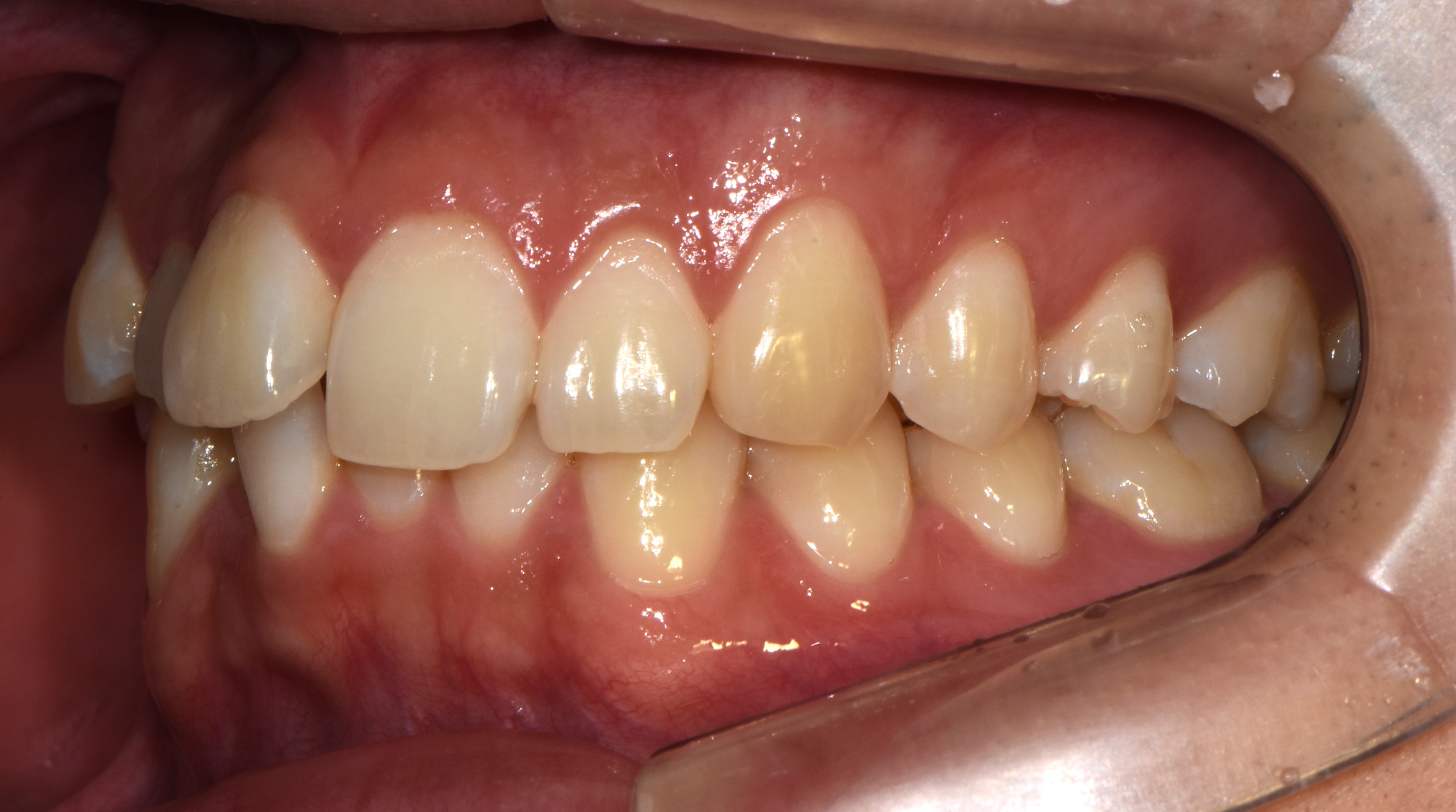 치료 전 사진입니다.