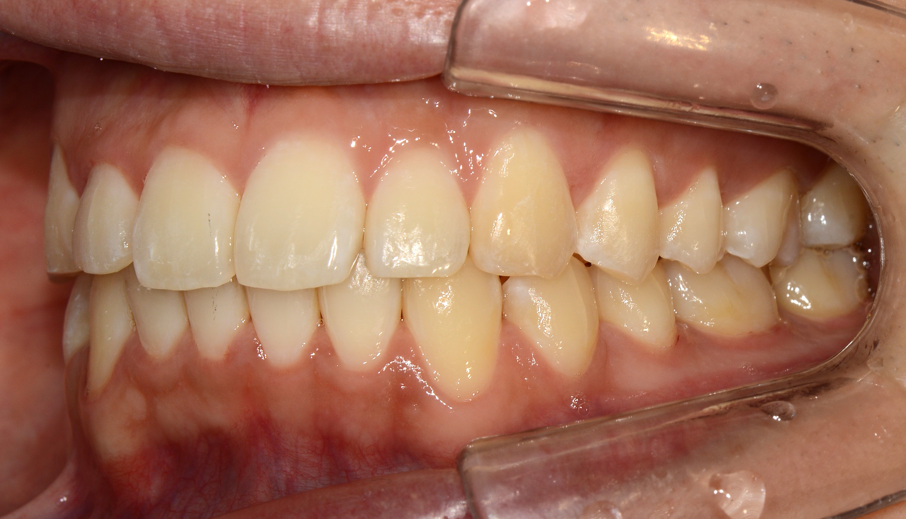 치료 후 사진입니다.