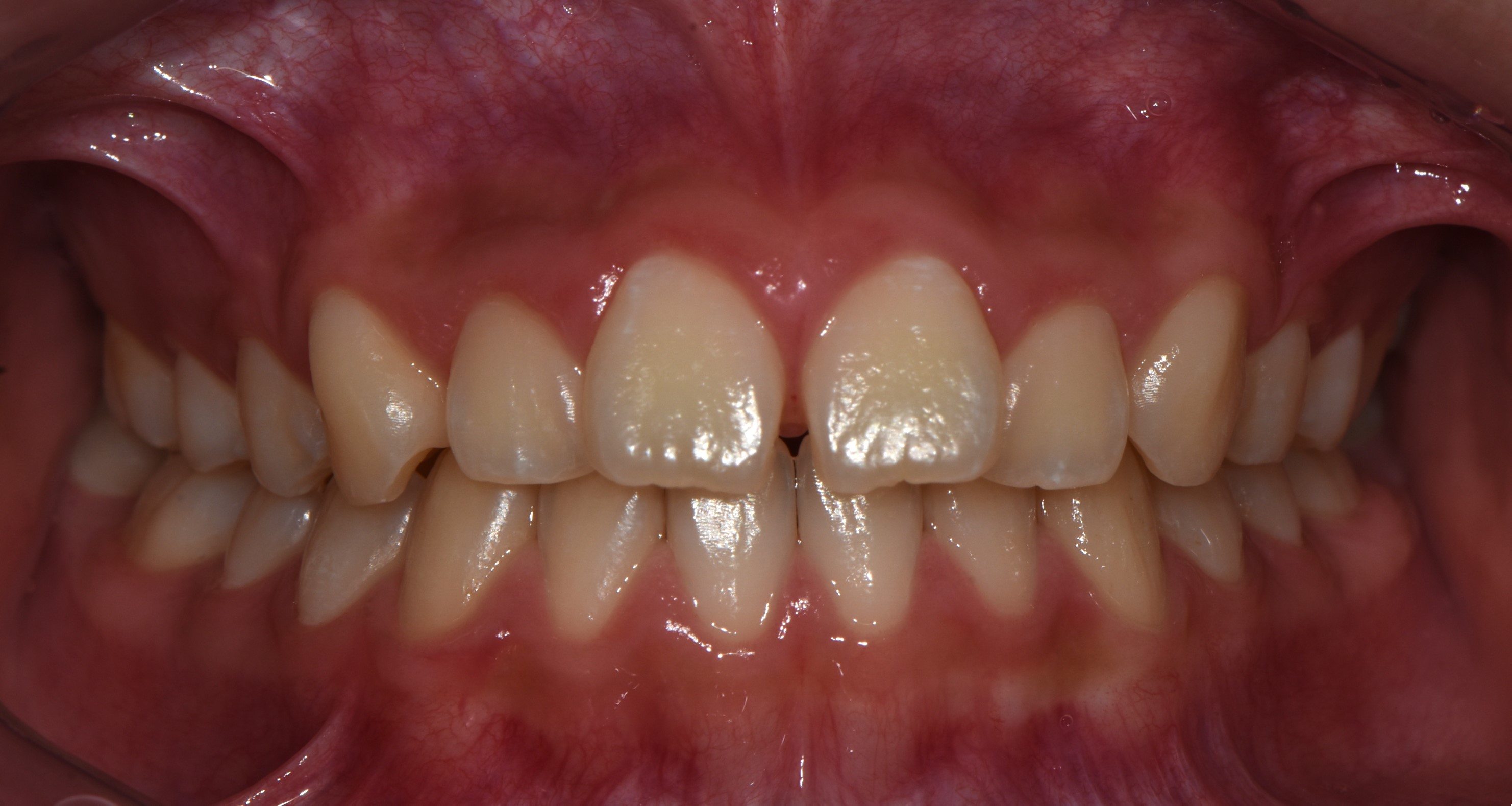 치료 전 사진입니다.