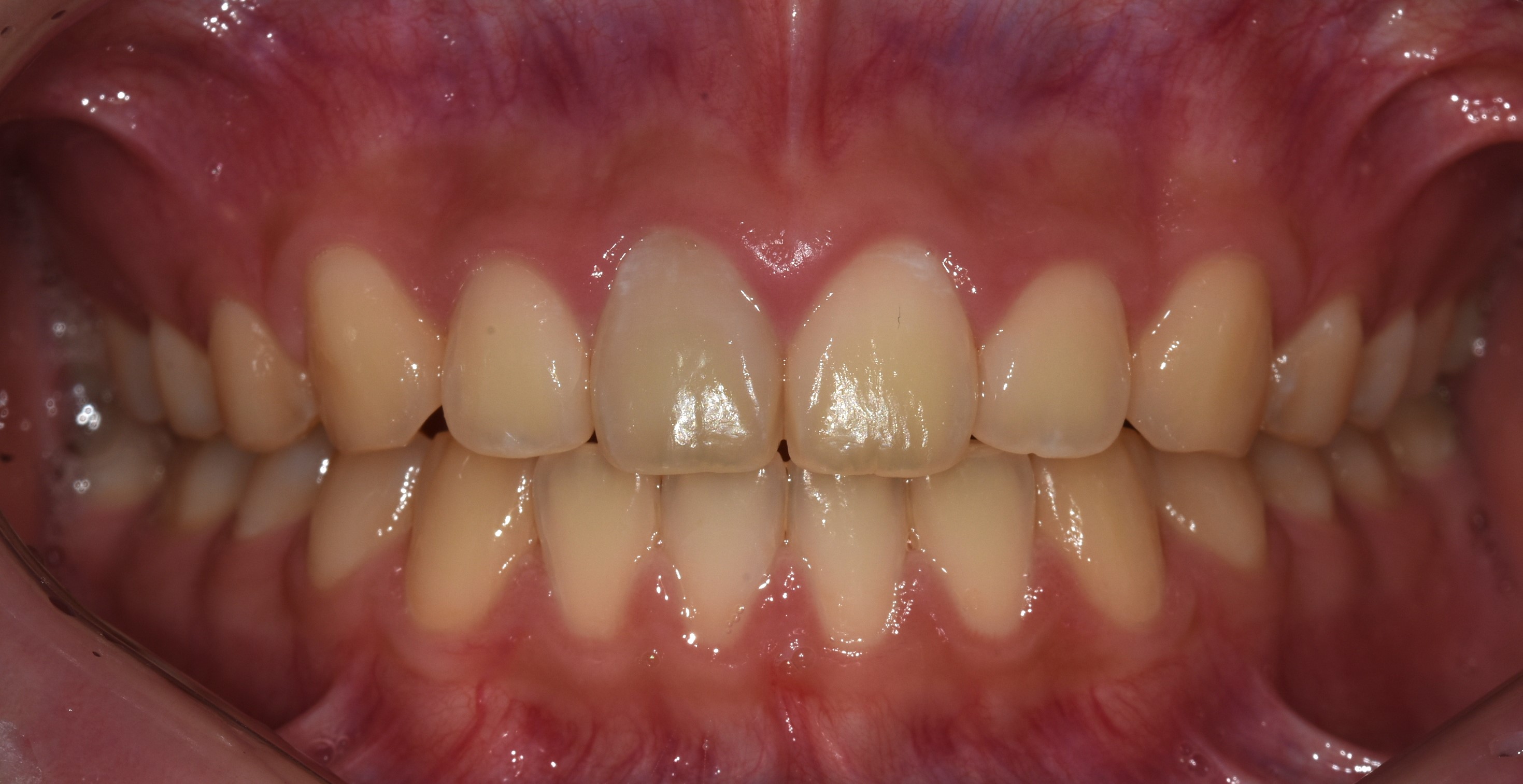 치료 후 사진입니다.