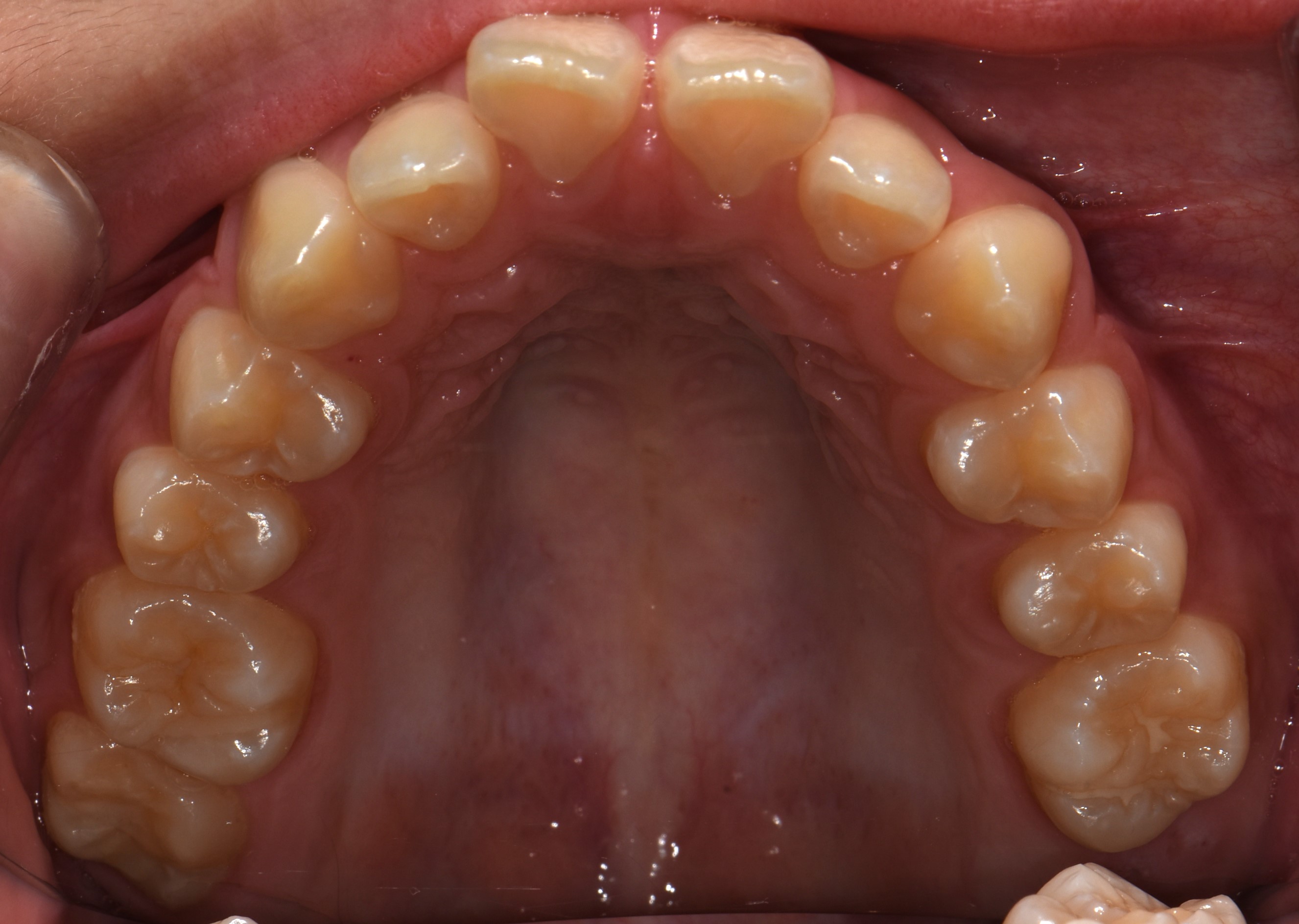 치료 전 사진입니다.