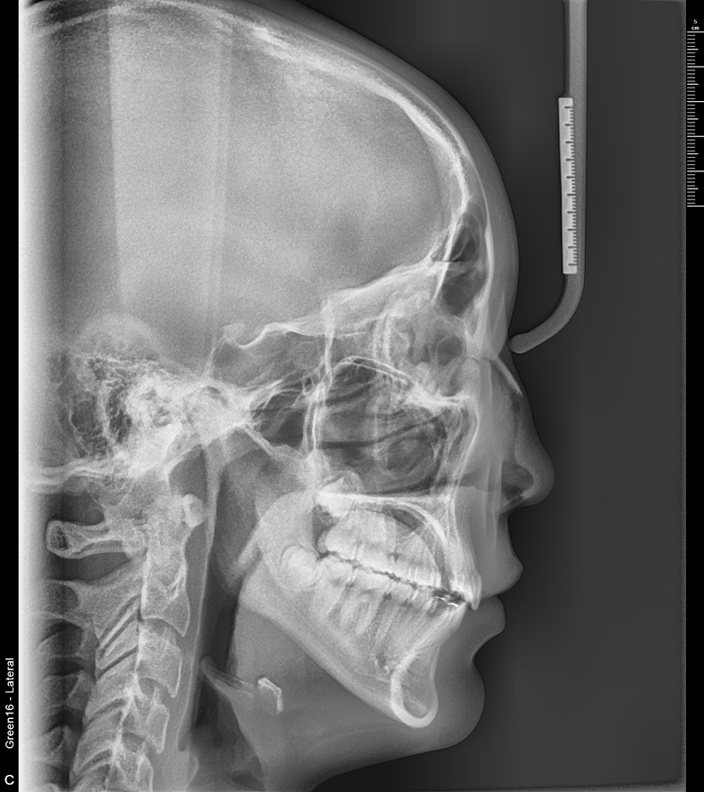 치료 후 사진입니다.