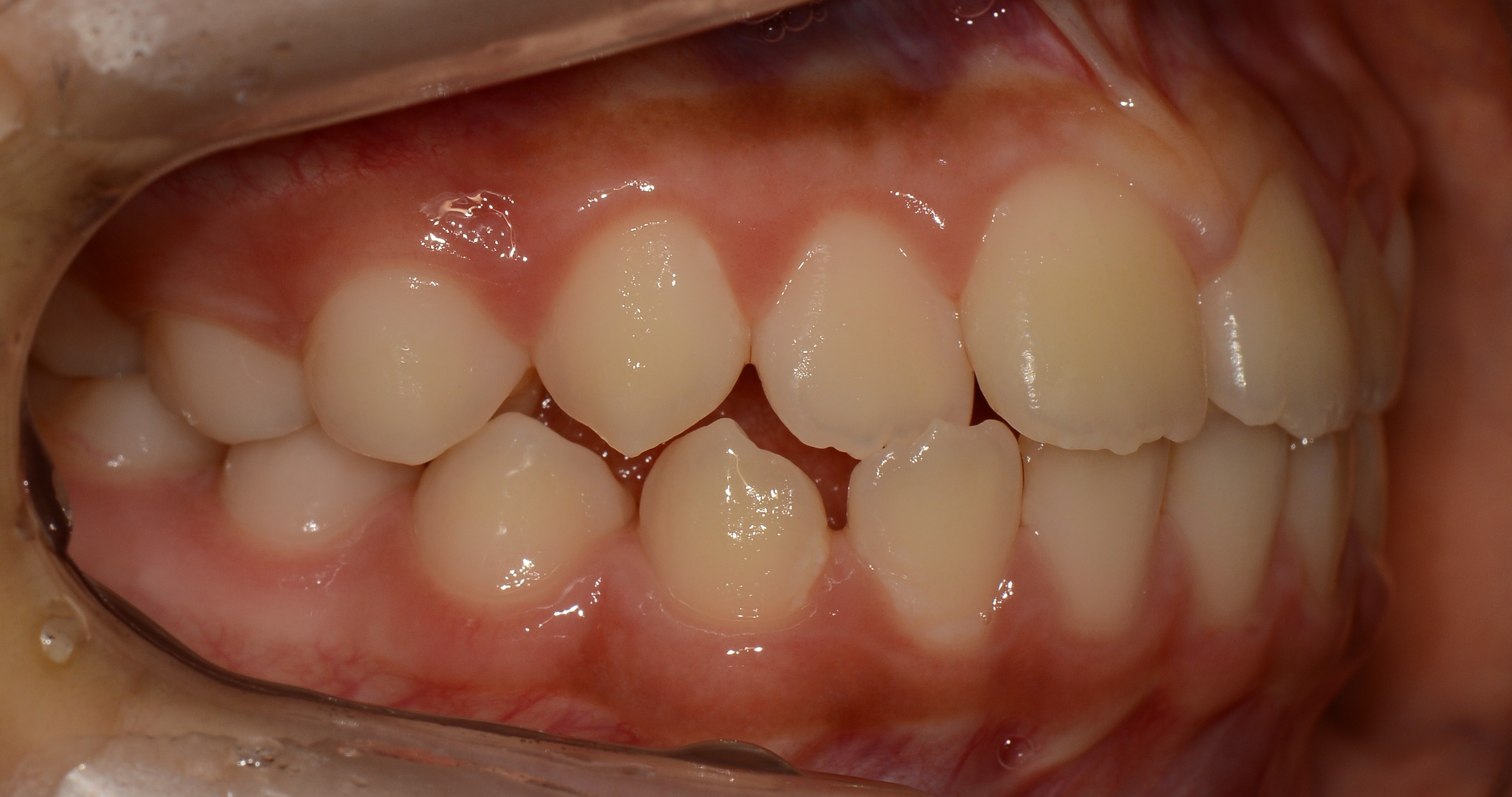 치료 전 사진입니다.