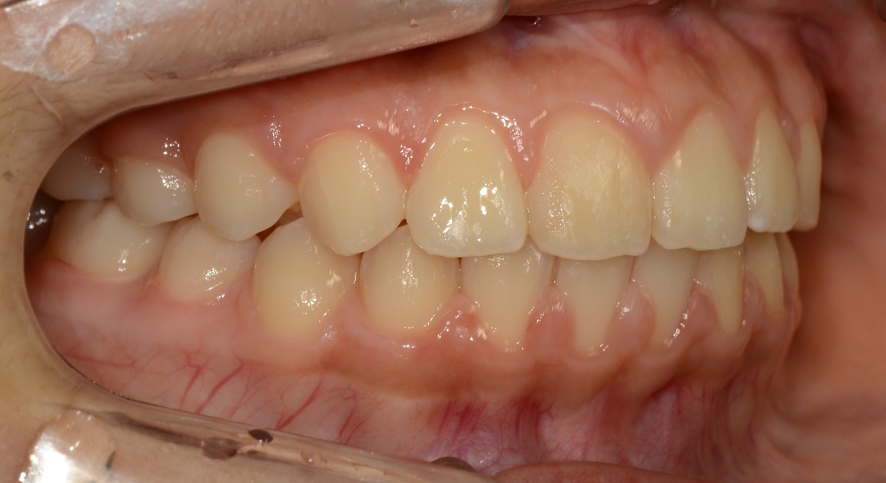 치료 후 사진입니다.