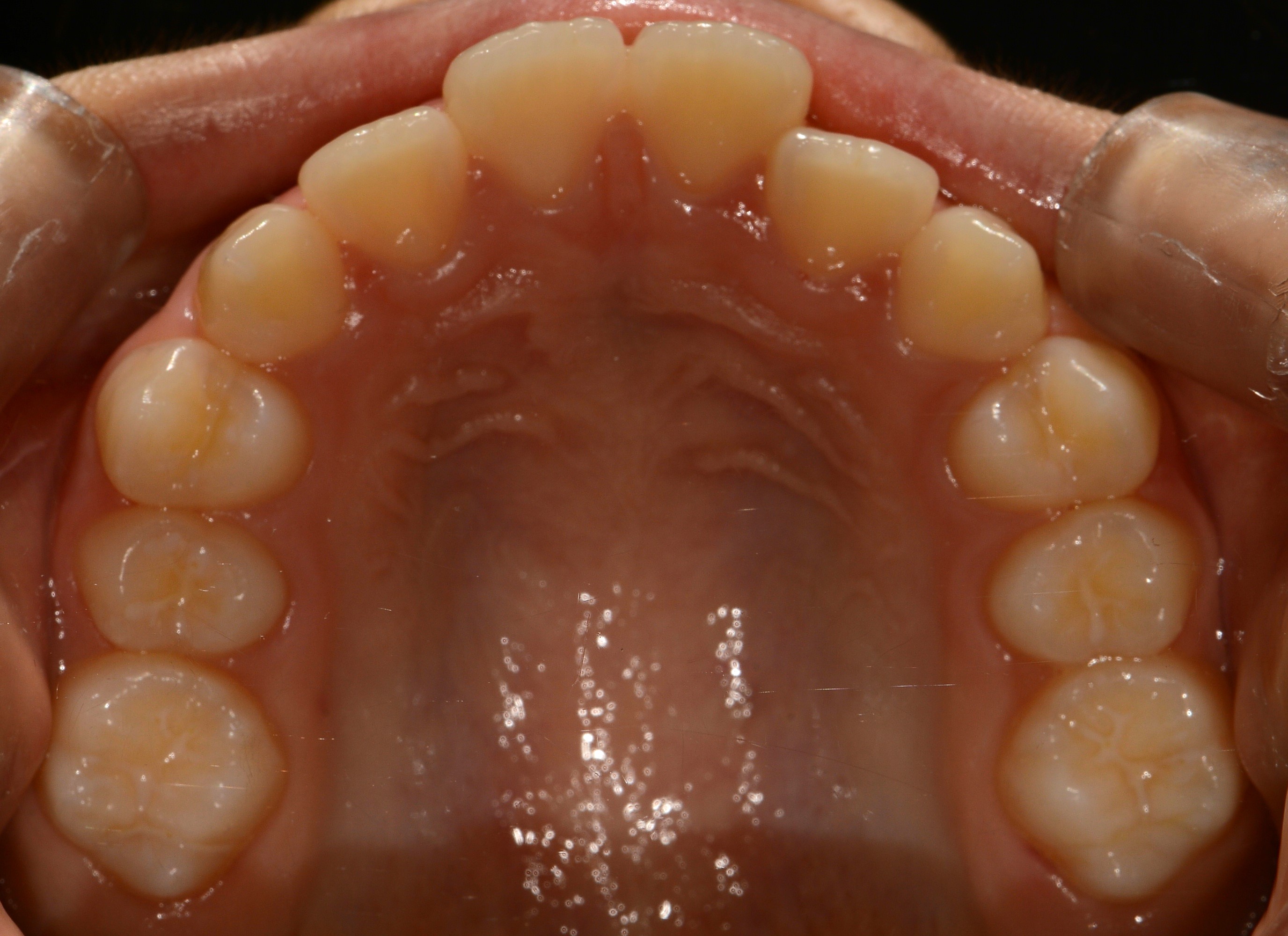 치료 전 사진입니다.