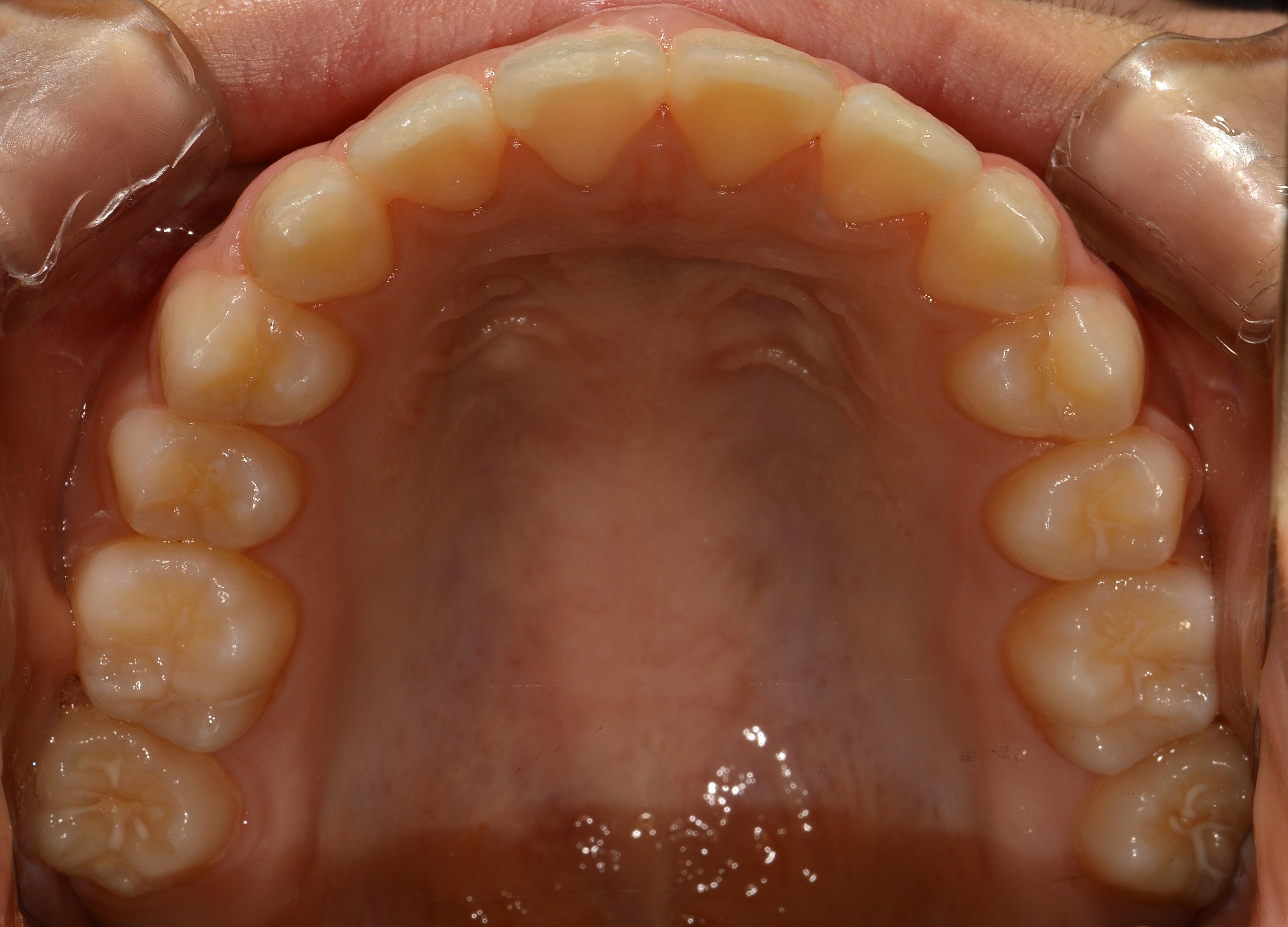 치료 후 사진입니다.