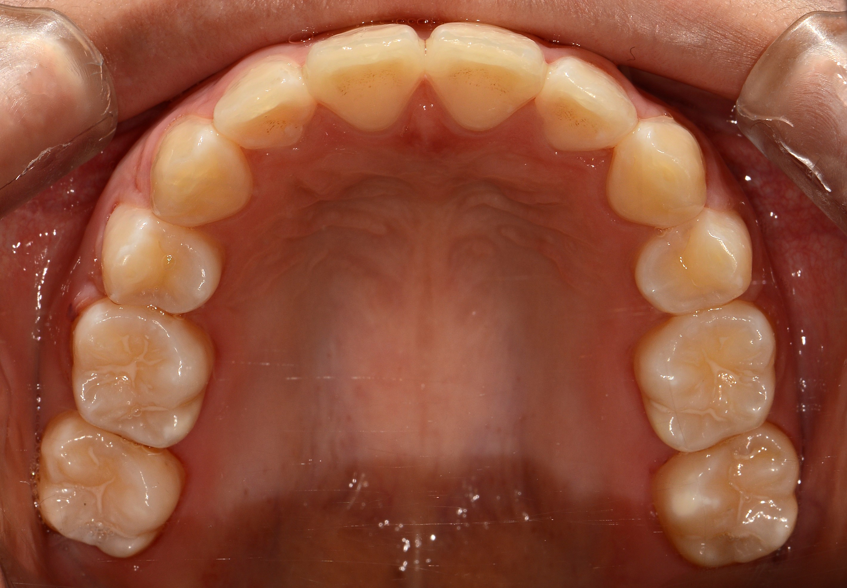 치료 후 사진입니다.