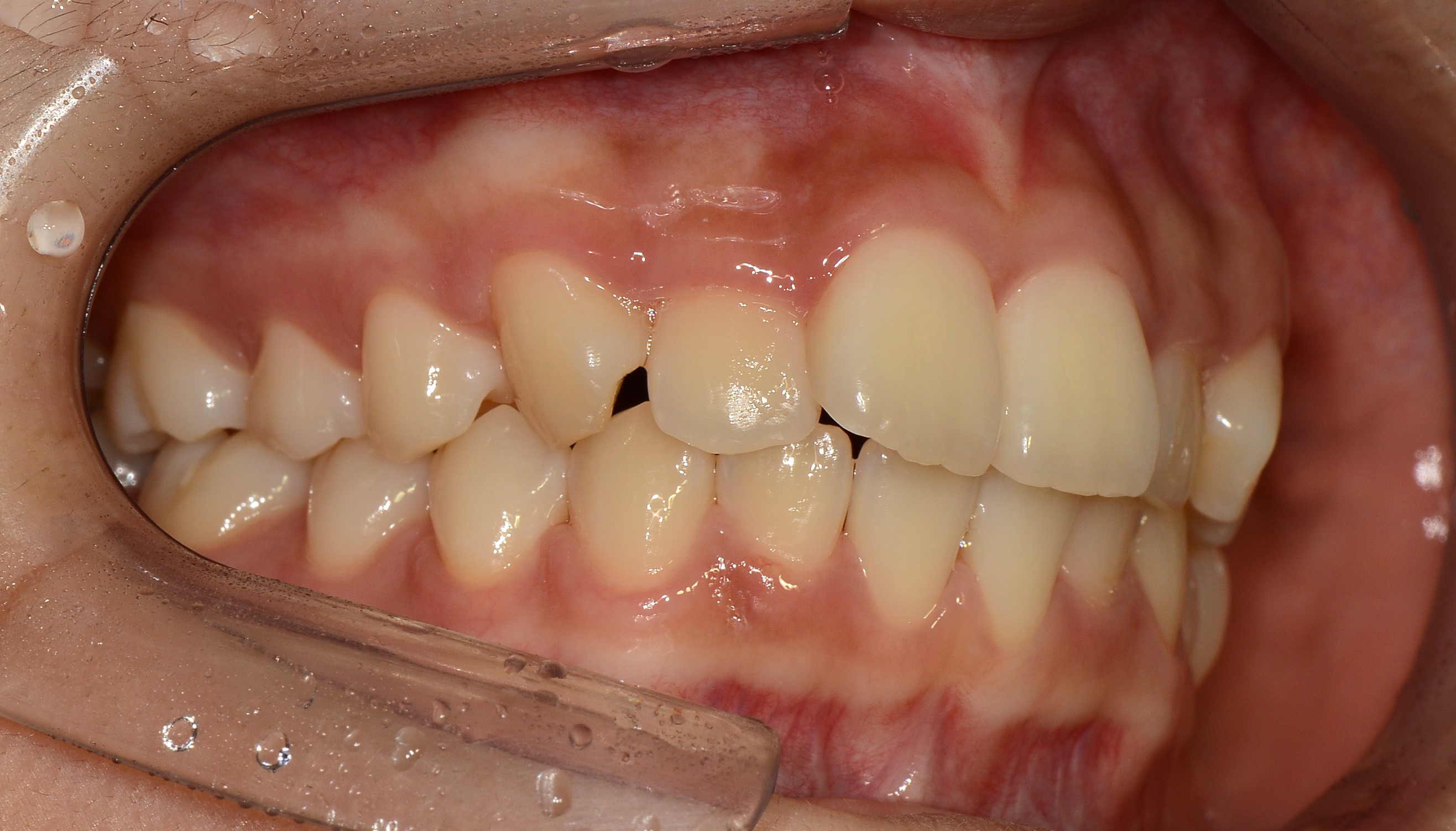 치료 전 사진입니다.