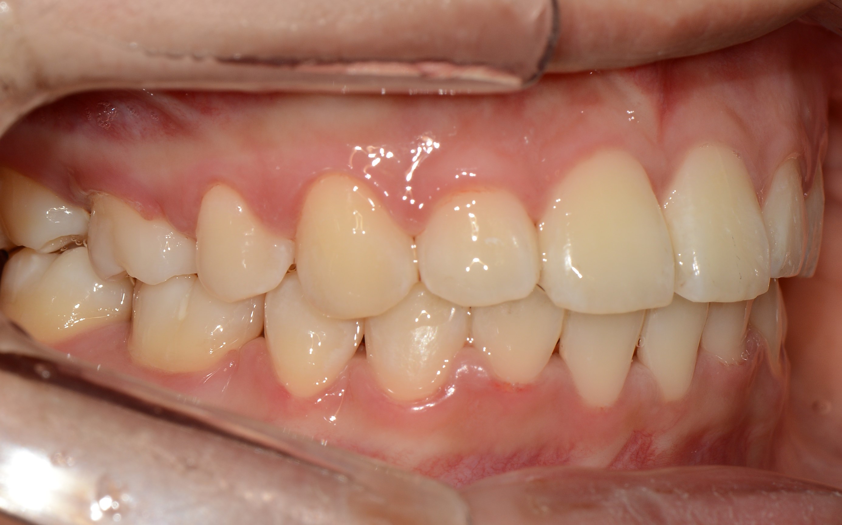 치료 후 사진입니다.