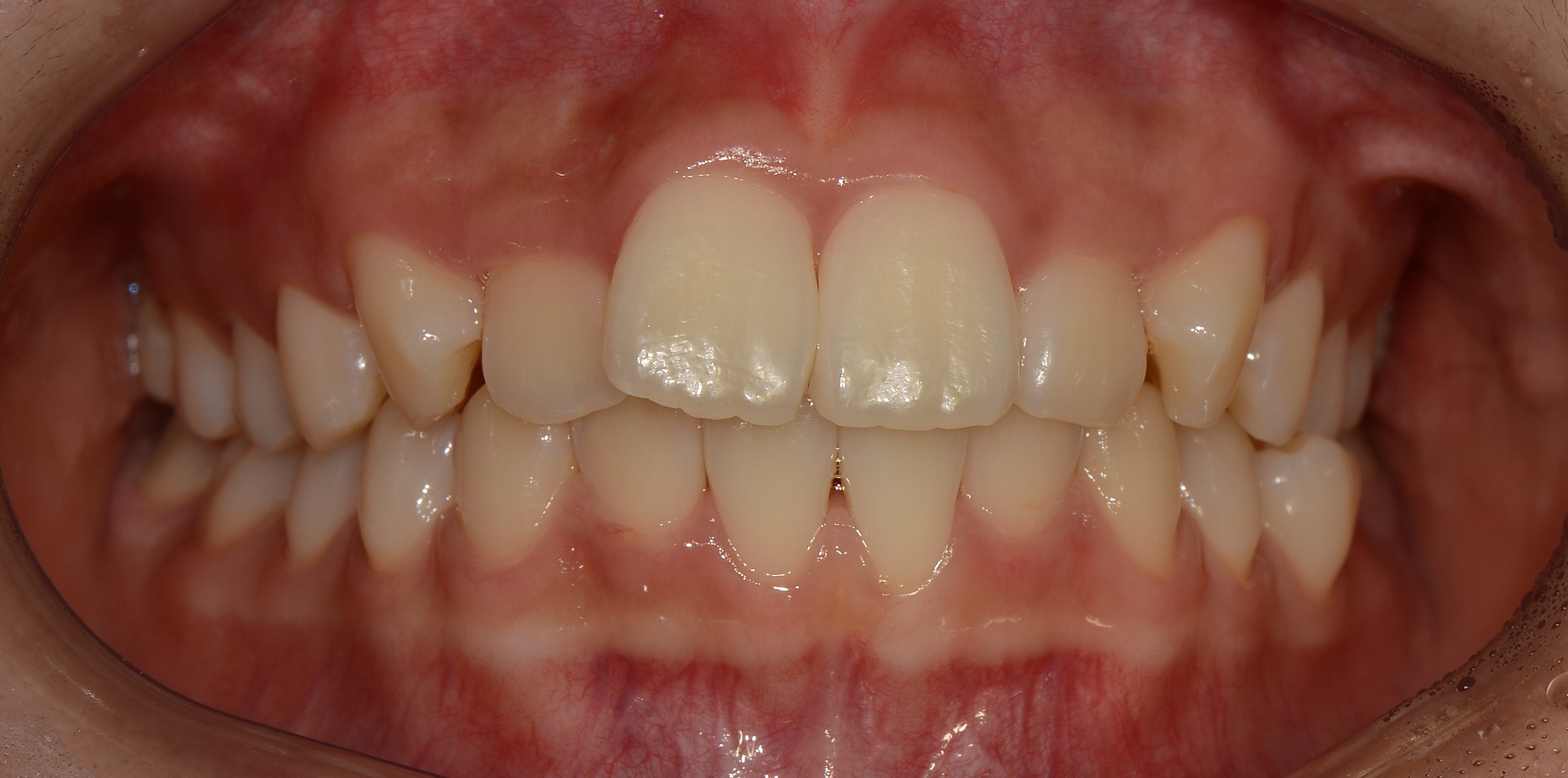 치료 전 사진입니다.