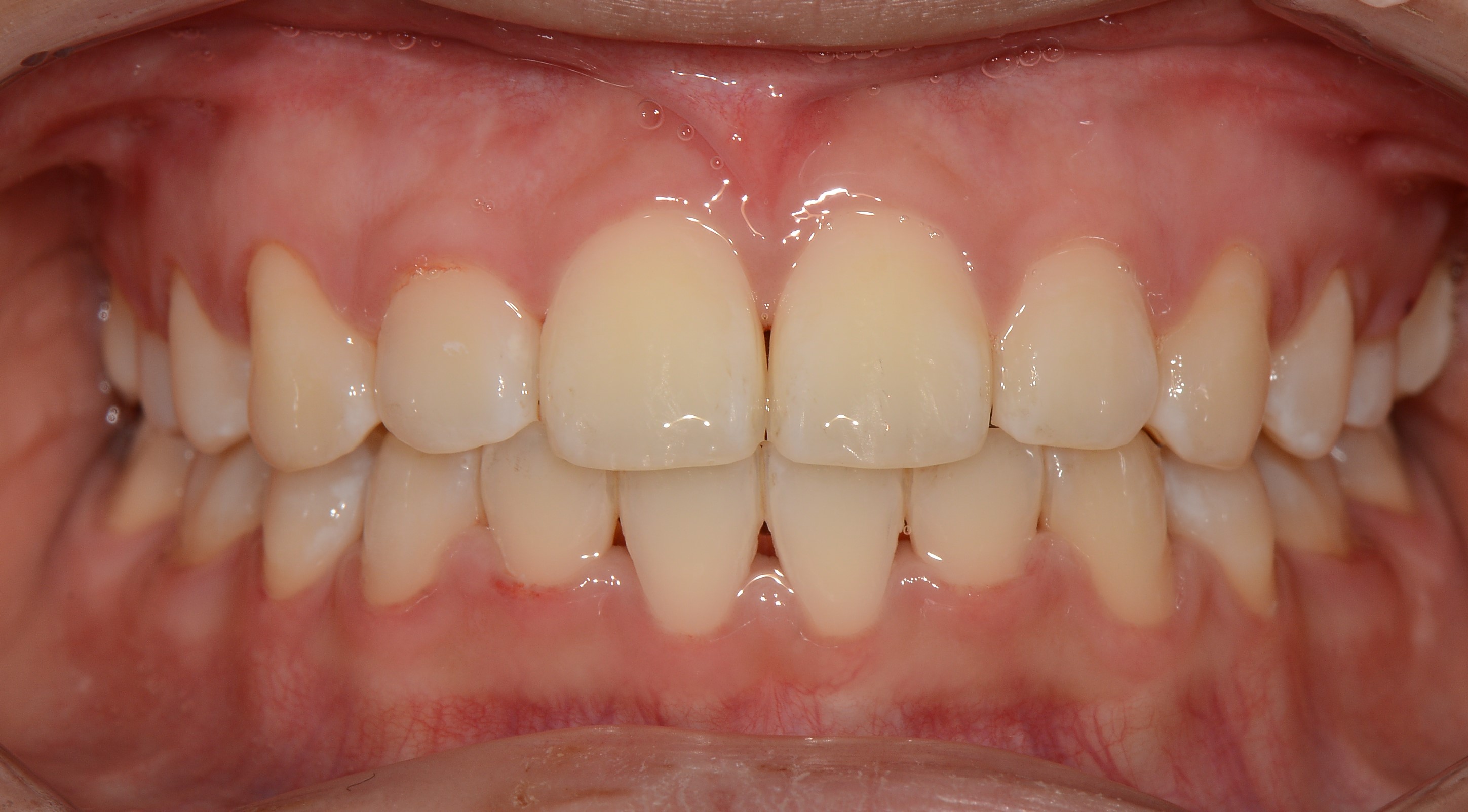 치료 후 사진입니다.